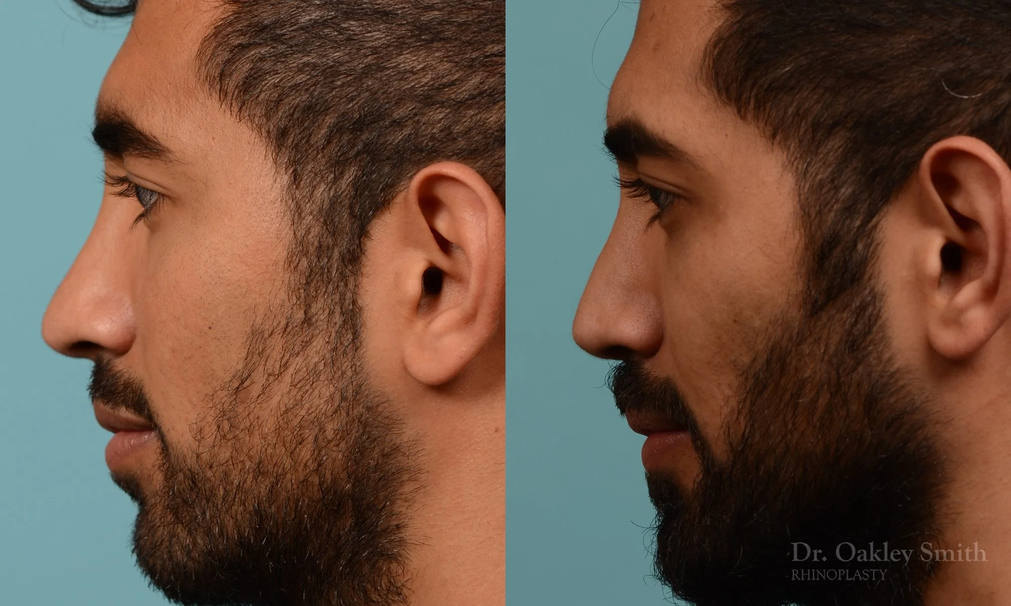 201.1E-rhinoplasty-dr-oakley-smith-toronto-nose-job.jpg