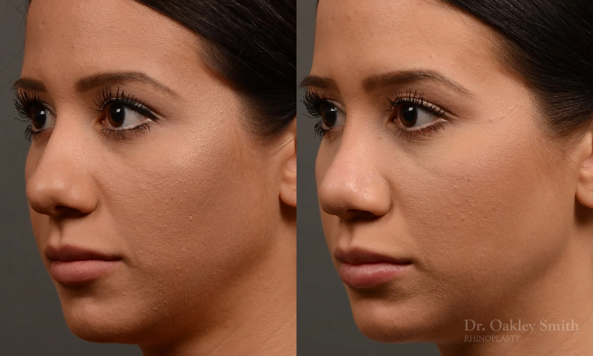 328D-rhinoplasty-dr-oakley-smith-toronto-nose-job.jpg