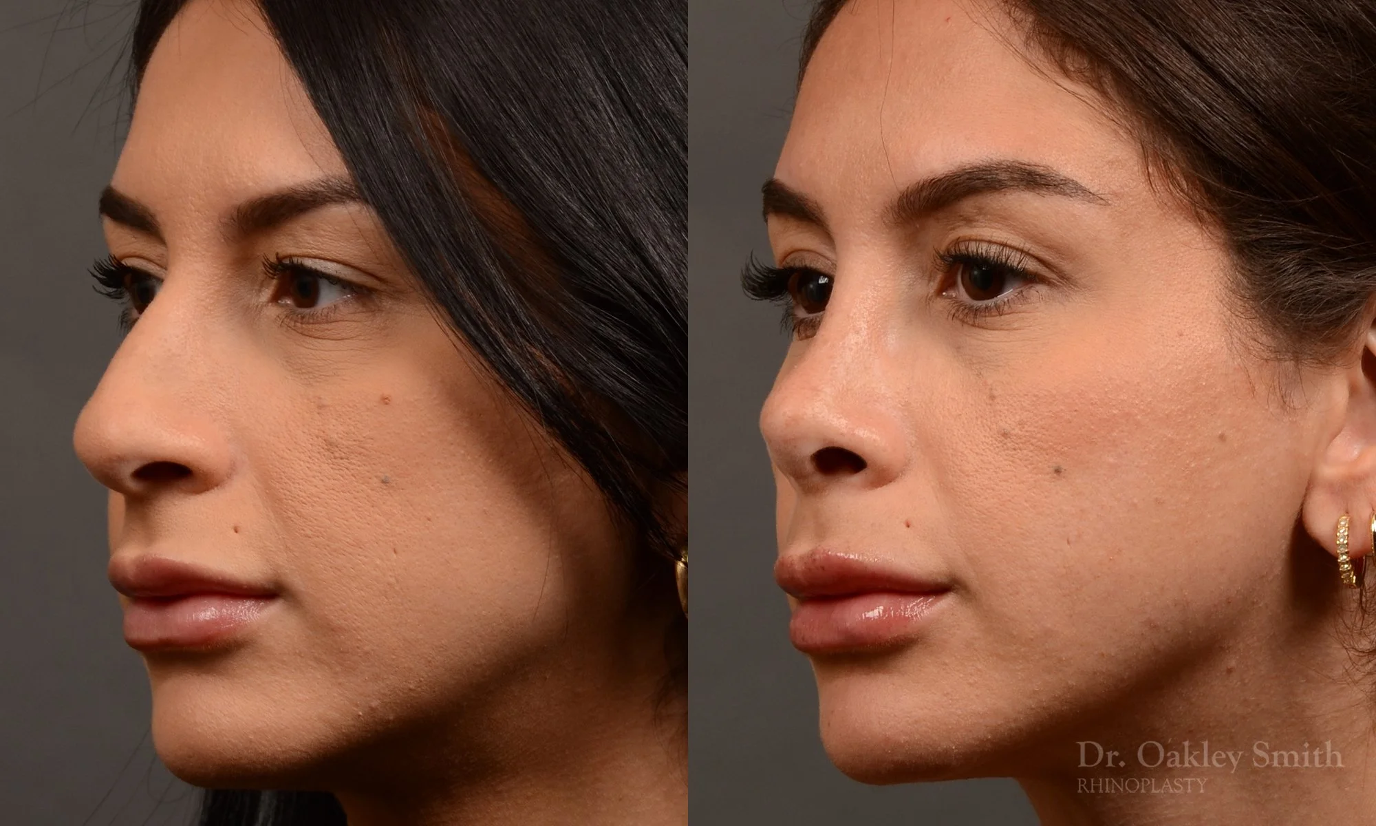 540D-rhinoplasty-dr-oakley-smith-toronto-nose-job.jpg