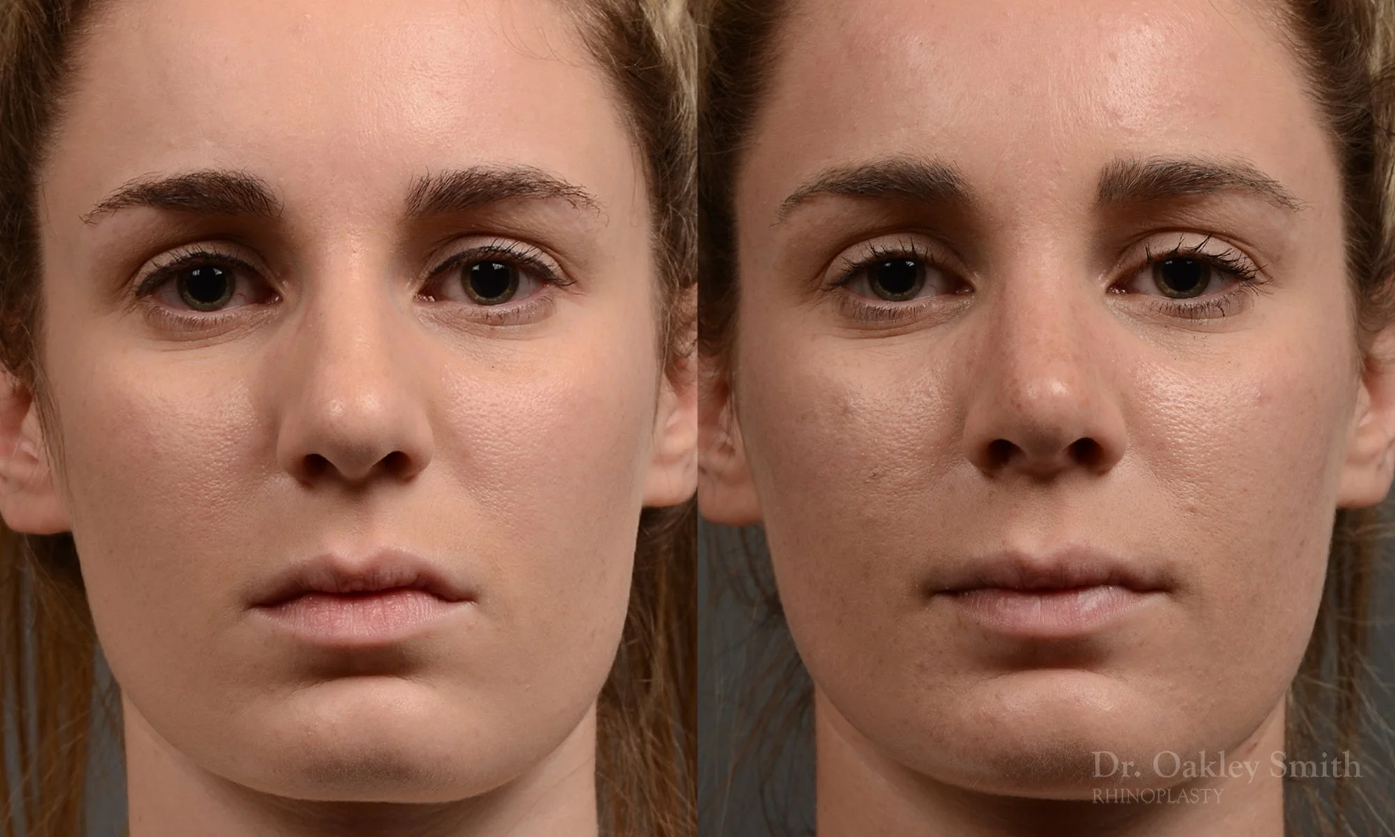 358A-rhinoplasty-dr-oakley-smith-toronto-nose-job.jpg