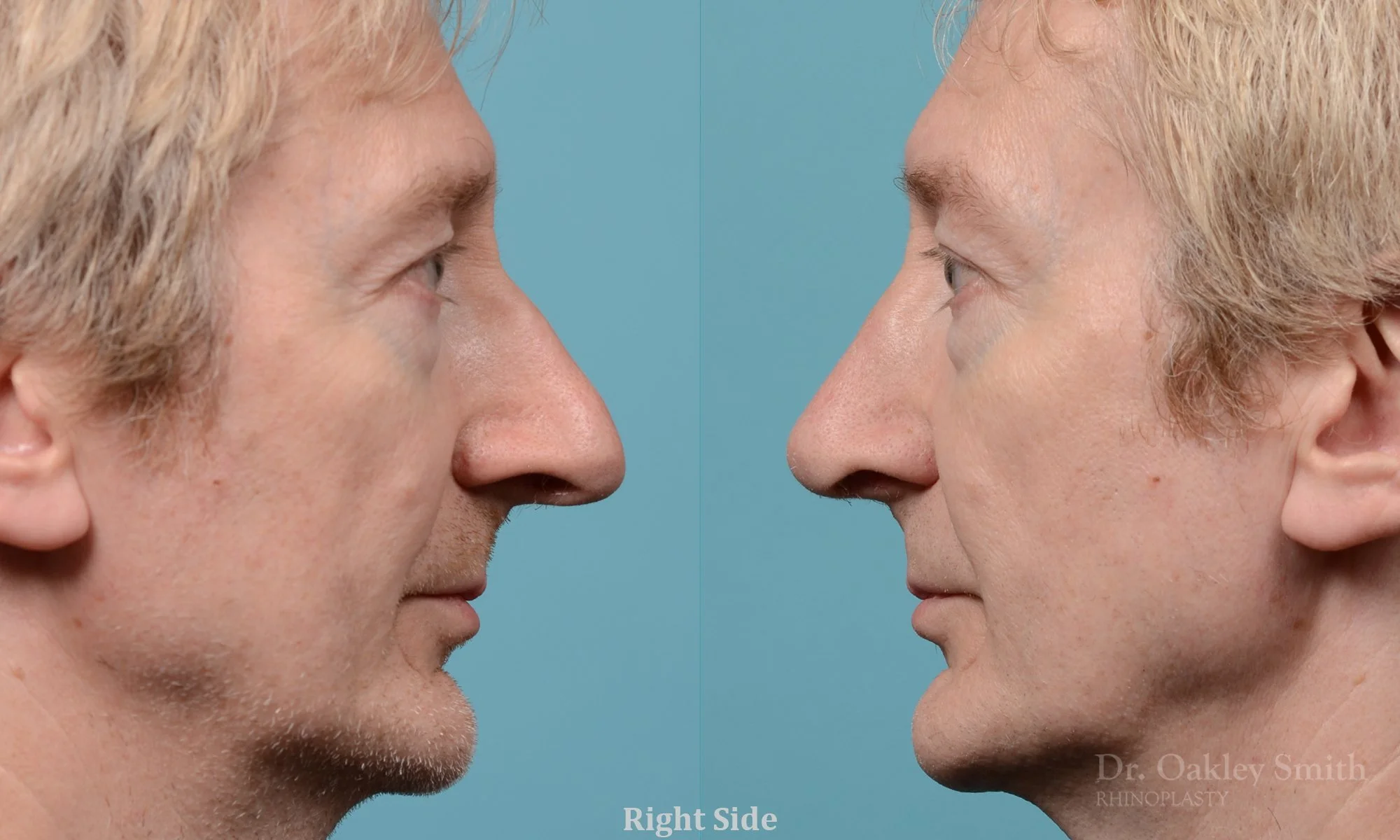 276: Primary Male Rhinoplasty, Normal Skin,  Large Nose, Tip Refinement