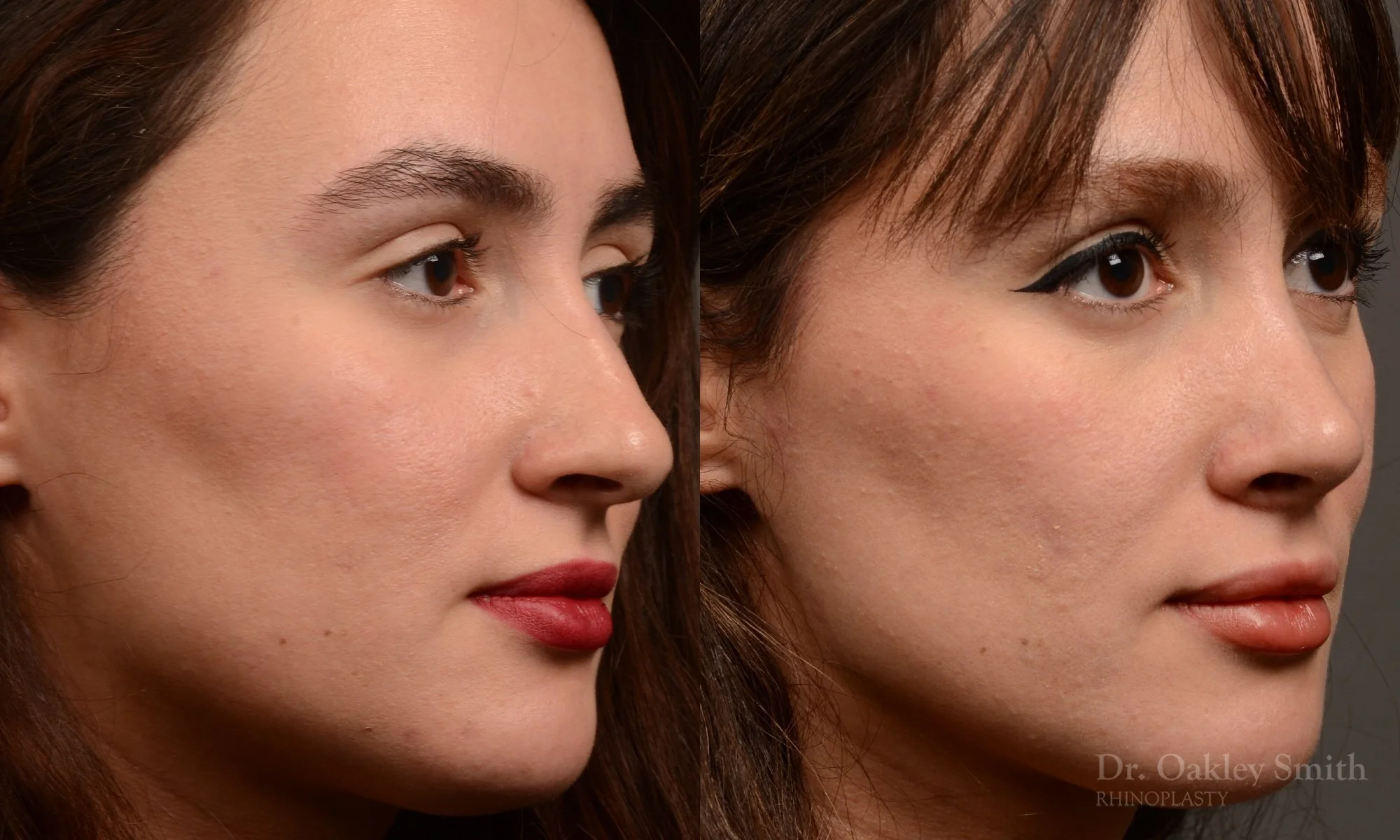 526B-rhinoplasty-dr-oakley-smith-toronto-top-surgeon-nose-job.jpg