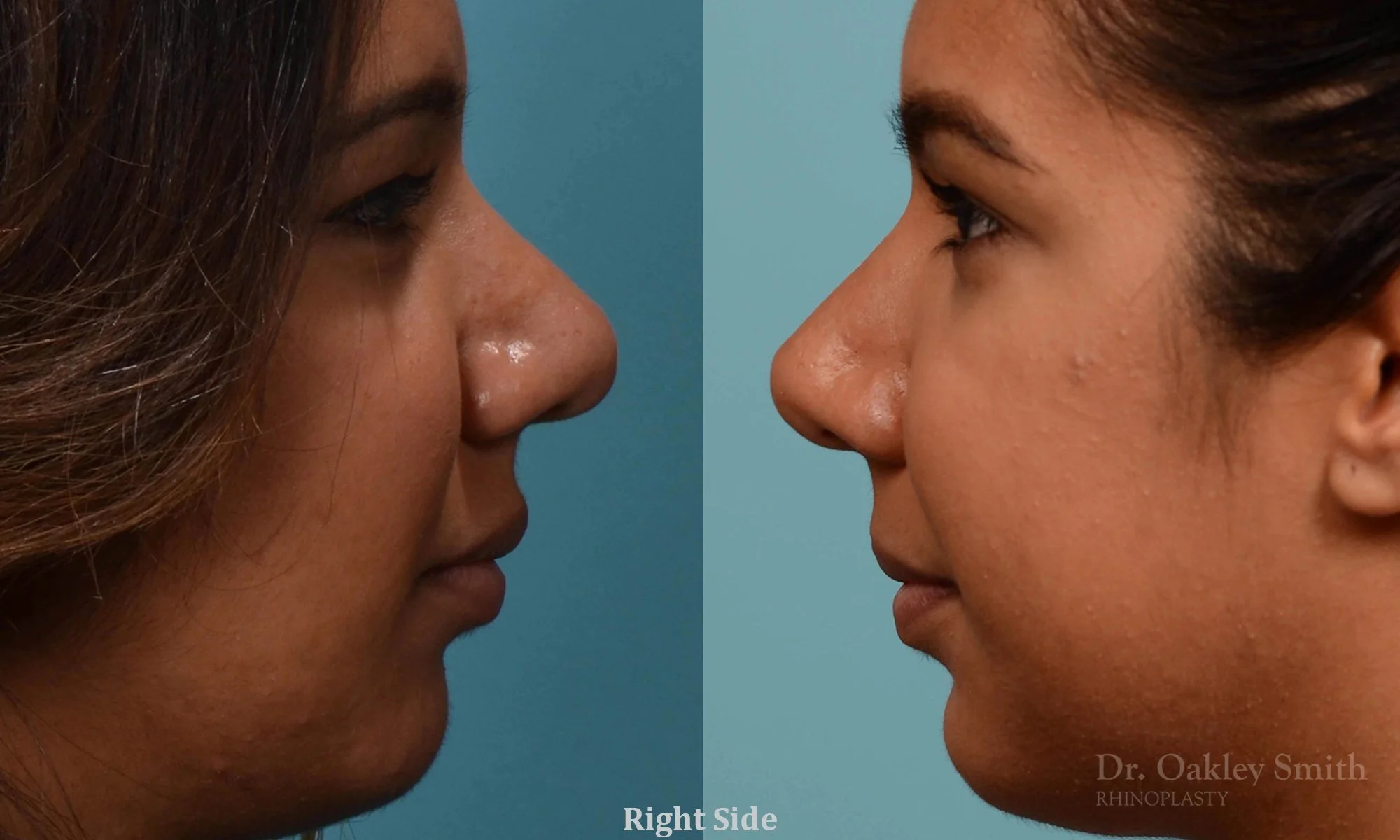 237C-rhinoplasty-dr-oakley-smith-1-1.jpg