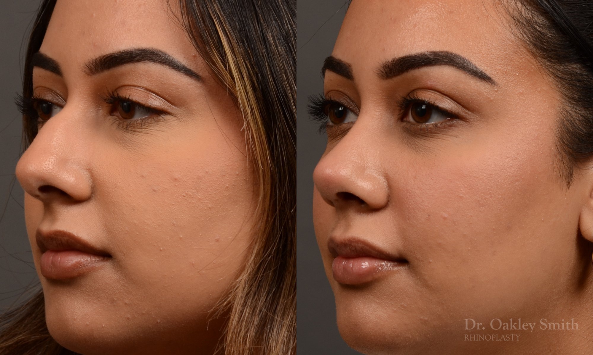 523D-rhinoplasty-dr-oakley-smith-toronto-top-surgeon-nose-job.jpg