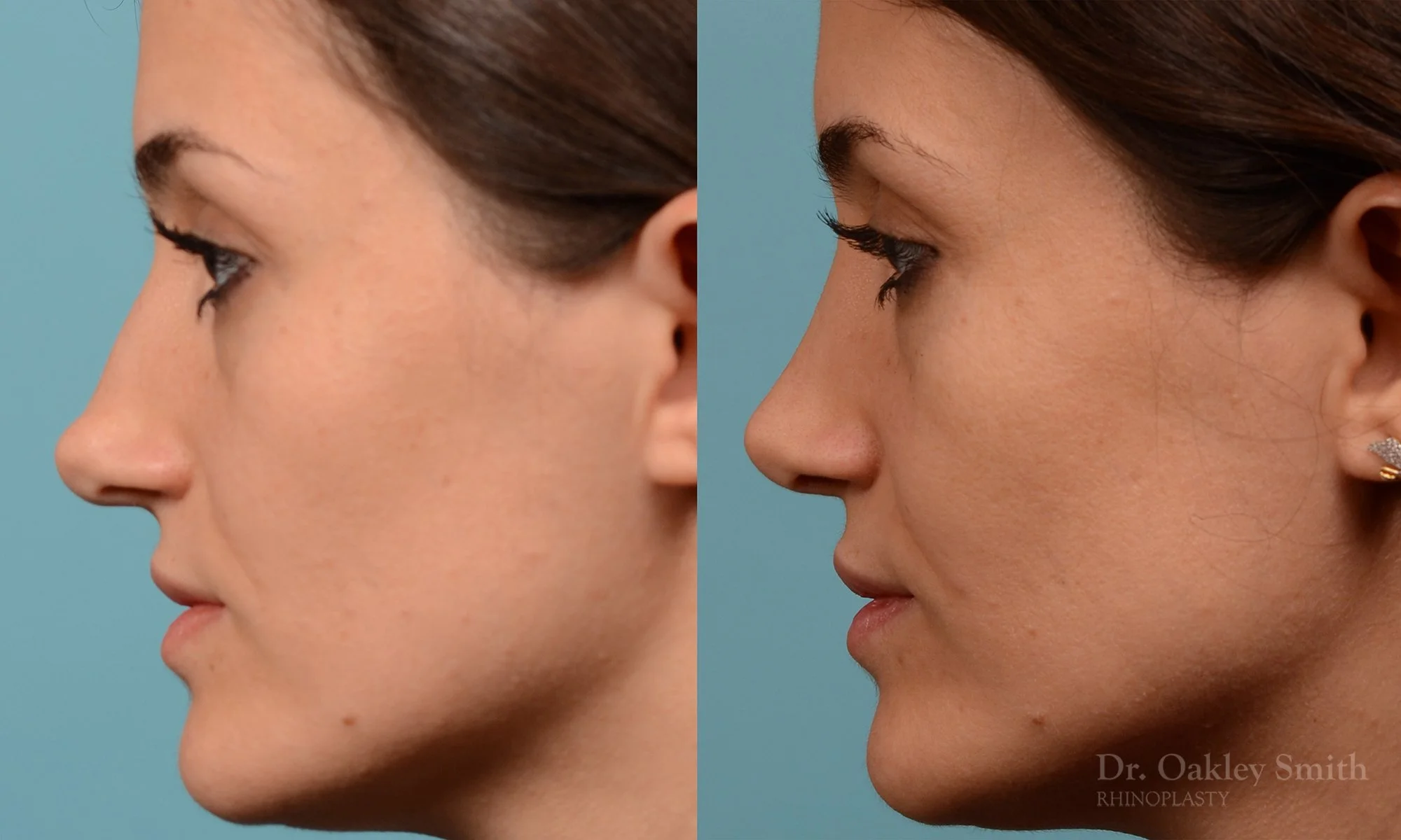 234E-nose-job-nose-reduction-rhinoplasty-pointy-nose-curved-nose-dr-oakley-smith-toronto.jpg