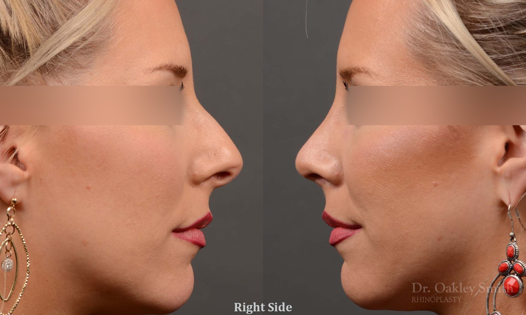 307: Female, Primary Rhinoplasty, Thin Skin, Dorsal Bump, Tip Rotation