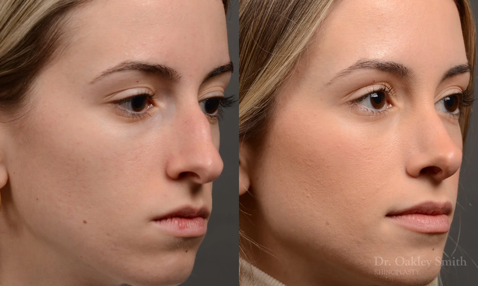 531B-rhinoplasty-dr-oakley-smith-toronto-top-surgeon-nose-job.jpg