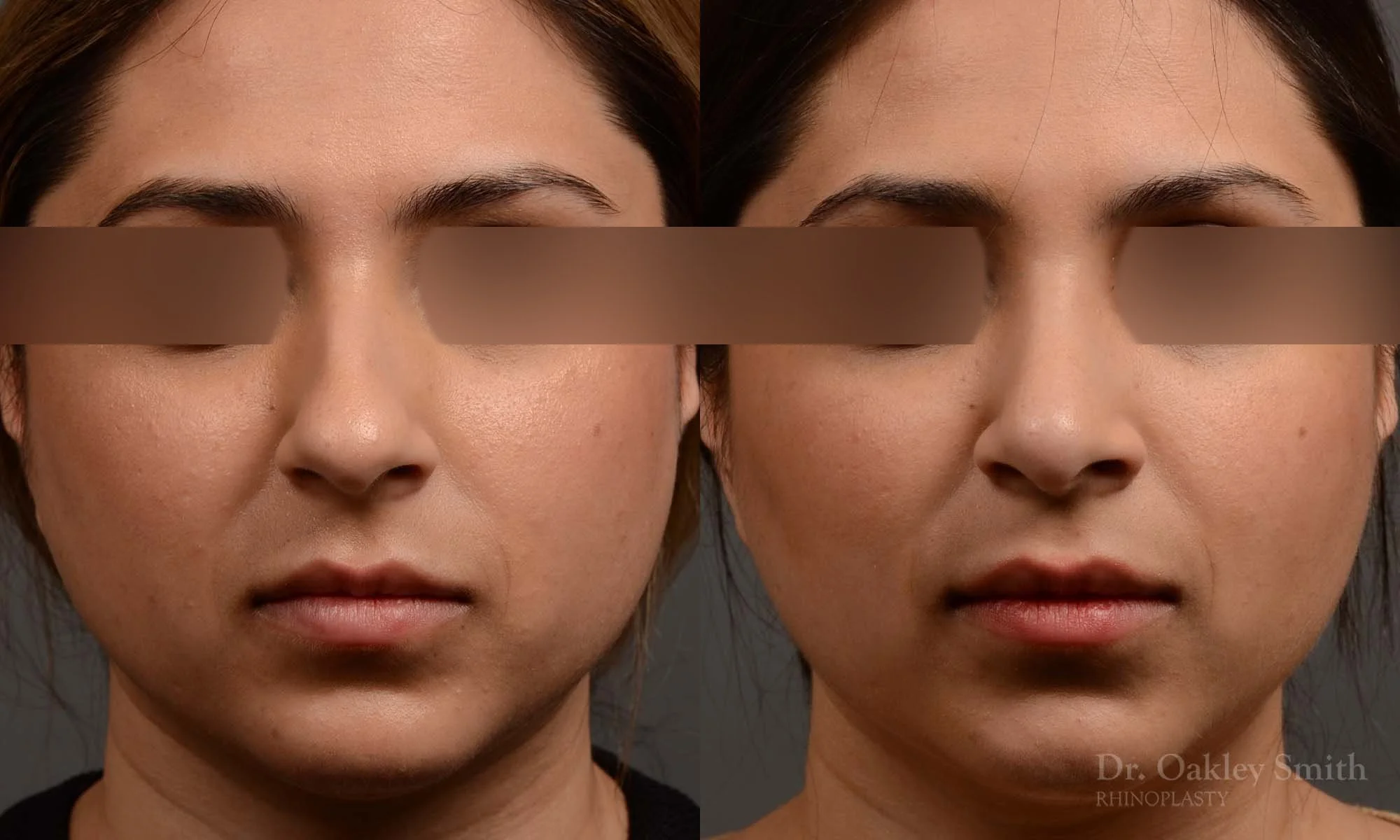 333A-rhinoplasty-dr-oakley-smith-toronto-nose-job.jpg