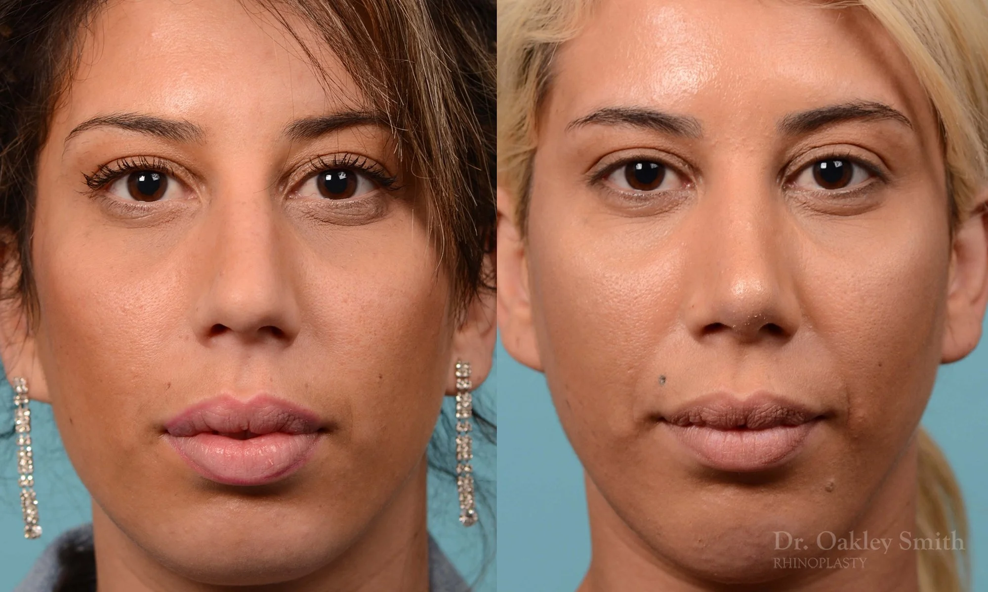 200A-nose-job-rhinoplasty-toronto-dr.-oakley-smith-septum-2.jpg