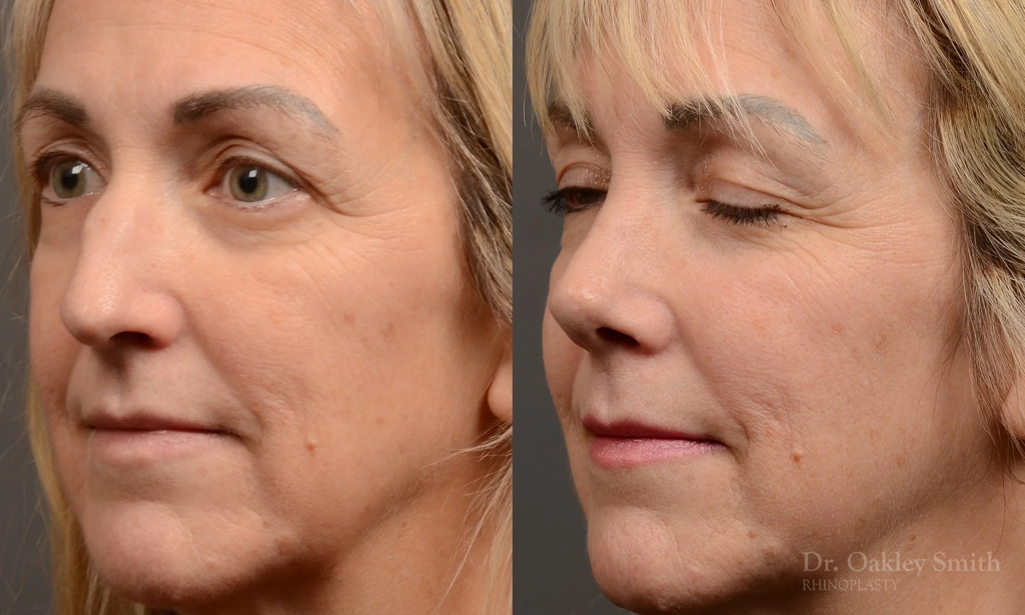 510D-rhinoplasty-dr-oakley-smith-toronto-top-surgeon-nose-job.jpg