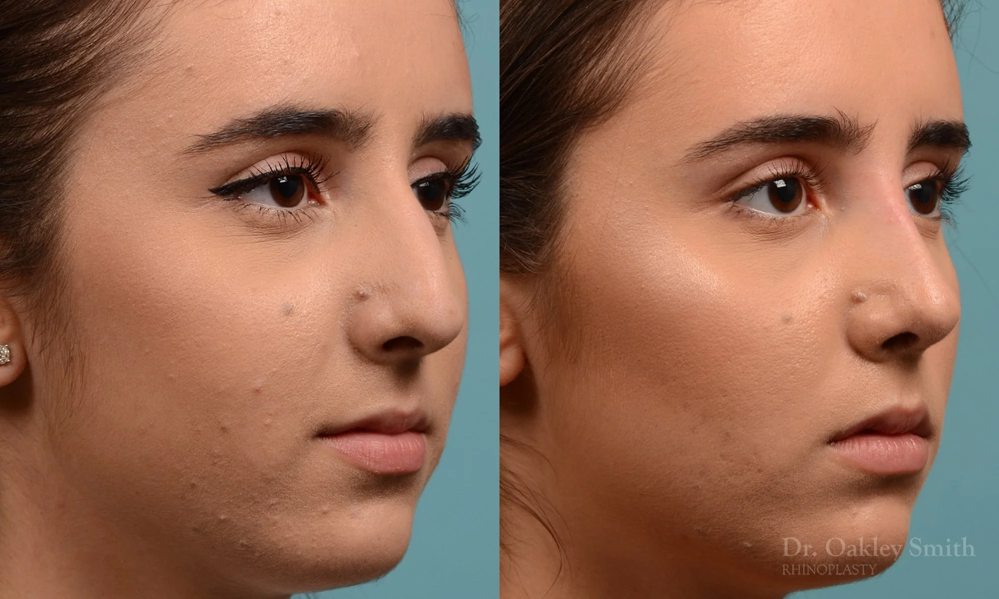 301B-rhinoplasty-dr-oakley-smith-toronto-nose-job.jpg