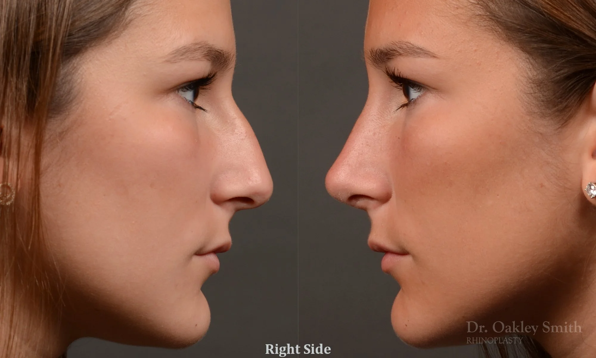 517C-rhinoplasty-dr-oakley-smith-toronto-top-surgeon-nose-job.jpg