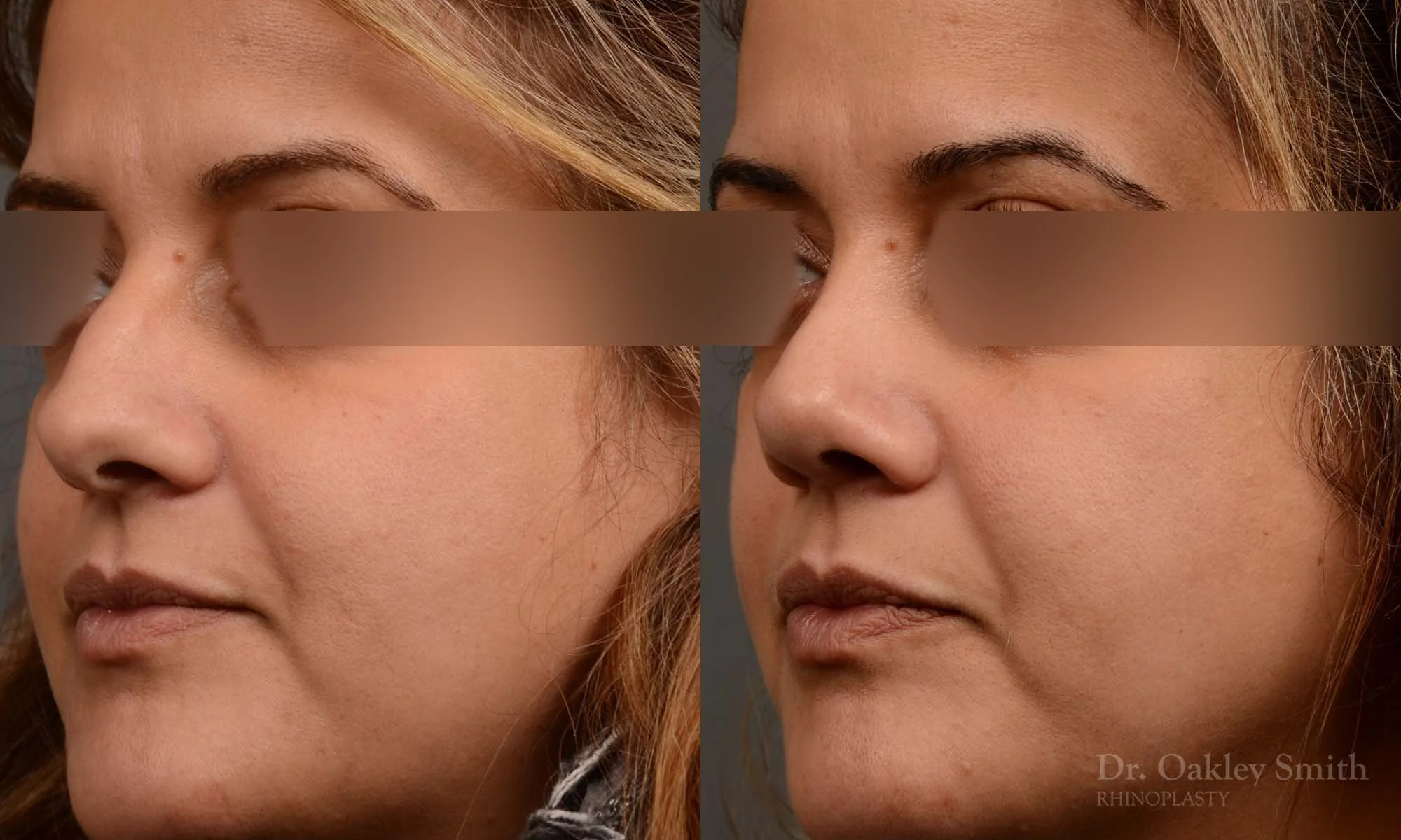 527D-rhinoplasty-dr-oakley-smith-toronto-top-surgeon-nose-job.jpg