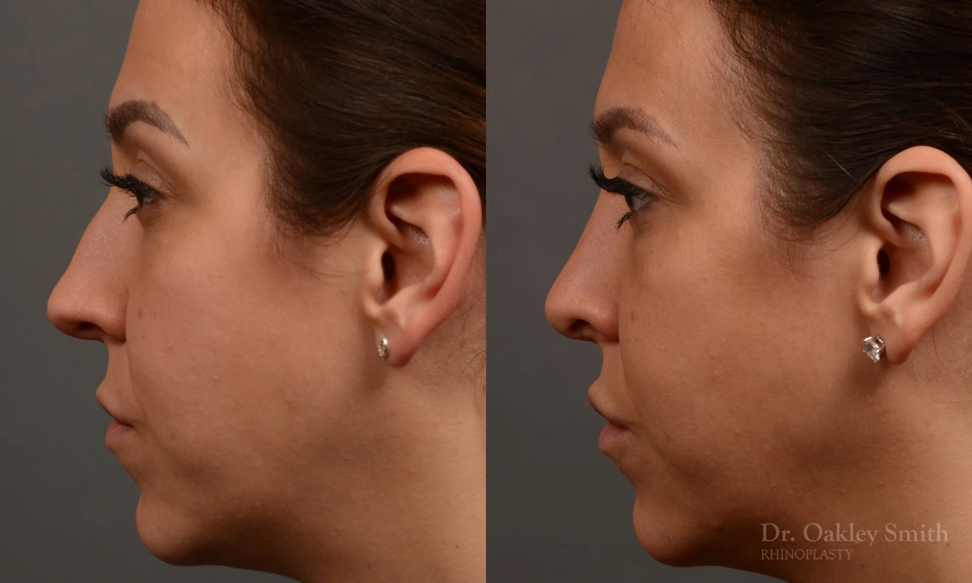 353E-rhinoplasty-dr-oakley-smith-toronto-nose-job.jpg