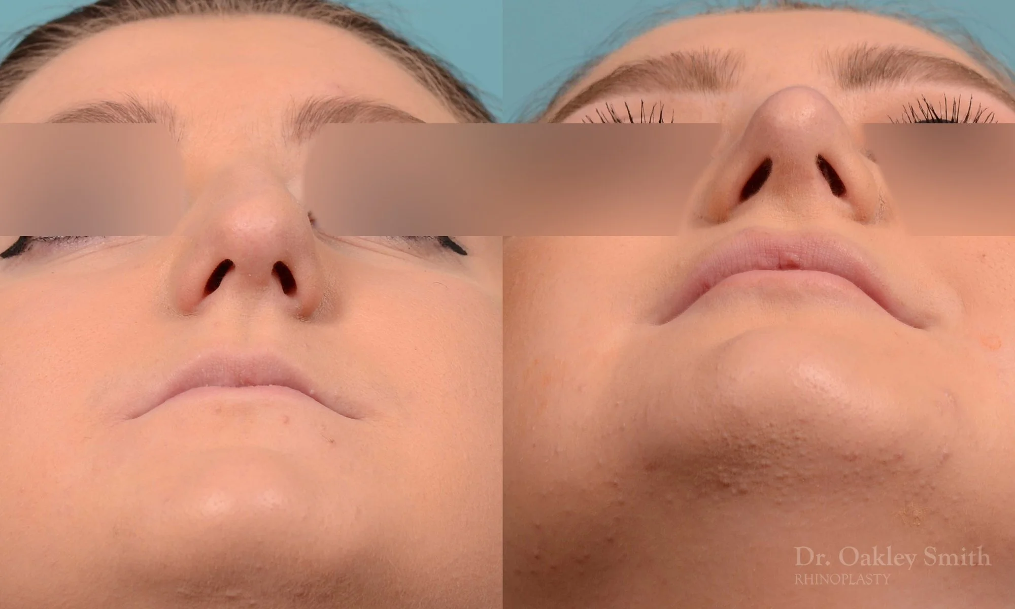235F-watermark-curved-nose-nose-job-dr-oakley-smith-toronto-rhinoplasty-bump-on-bridge.jpg