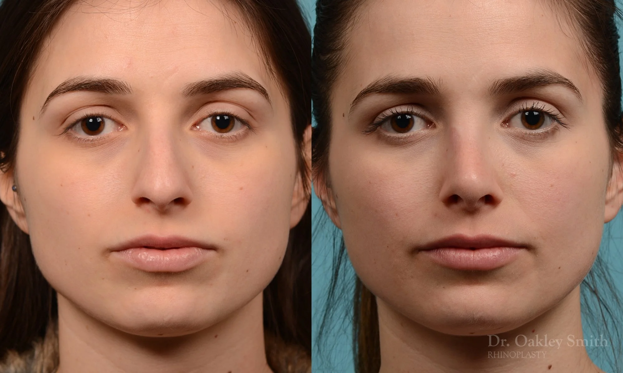 289A-rhinoplasty-dr-oakley-smith-toronto-nose-job.jpg