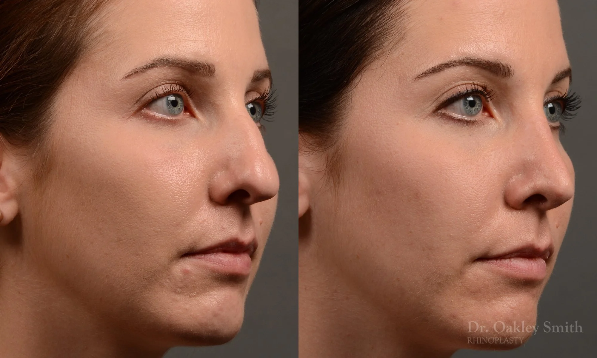 357B-rhinoplasty-dr-oakley-smith-toronto-nose-job - Copy.jpg