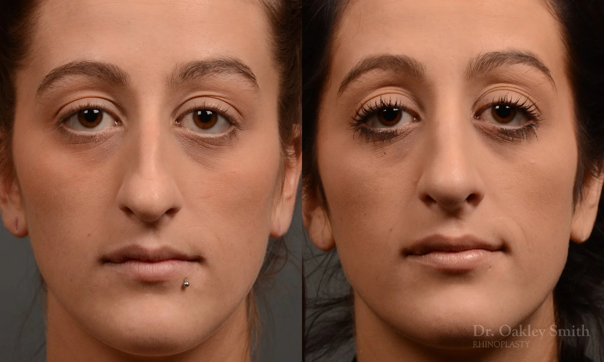 316A-rhinoplasty-dr-oakley-smith-toronto-nose-job.jpg