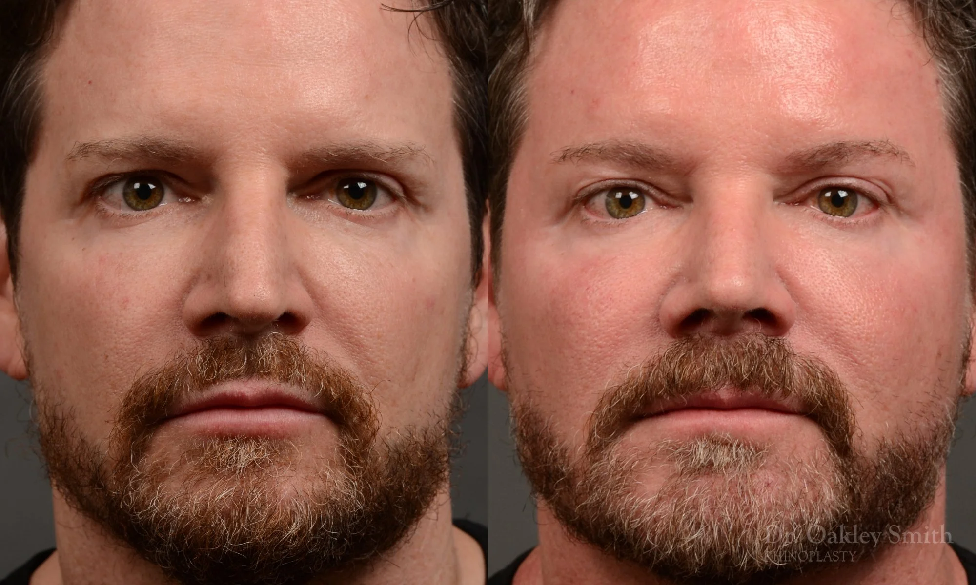Case 560, Dr. Oakley Smith, male rhinoplasty, 12 months after surgery, frontal view