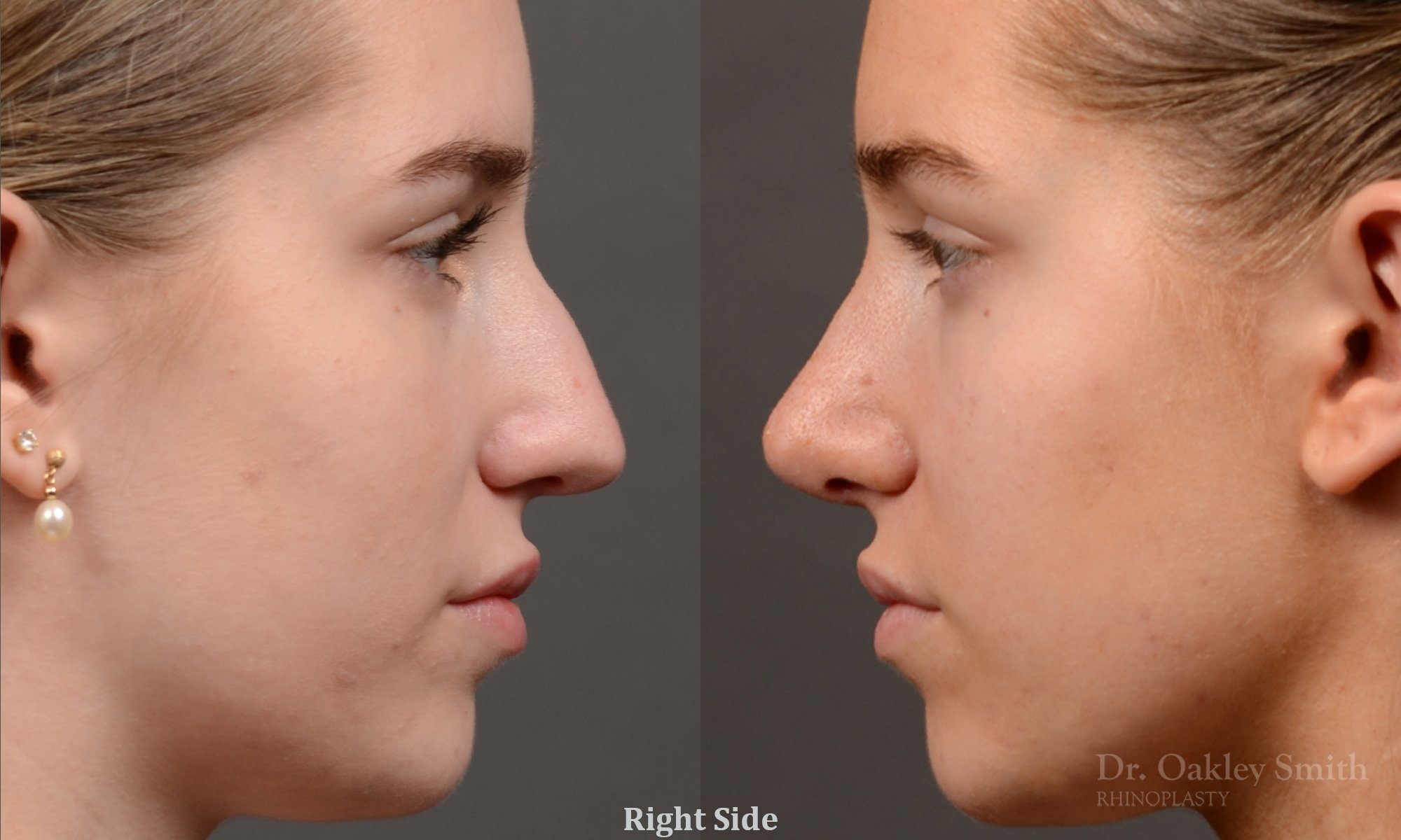 537C-rhinoplasty-before-after-top-toronto-nose-surgeon.jpg
