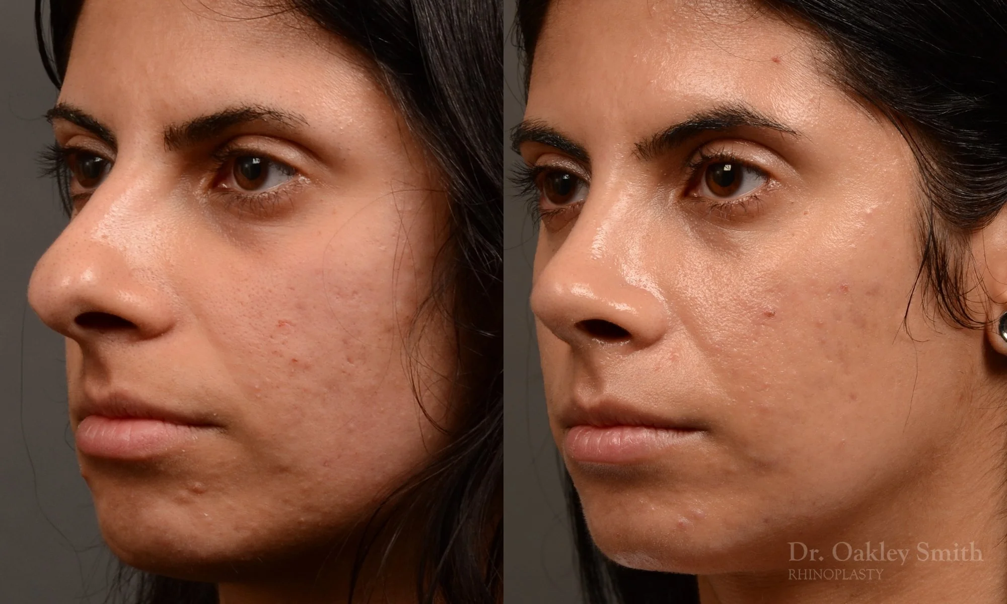 518D-rhinoplasty-dr-oakley-smith-toronto-top-surgeon-nose-job.jpg