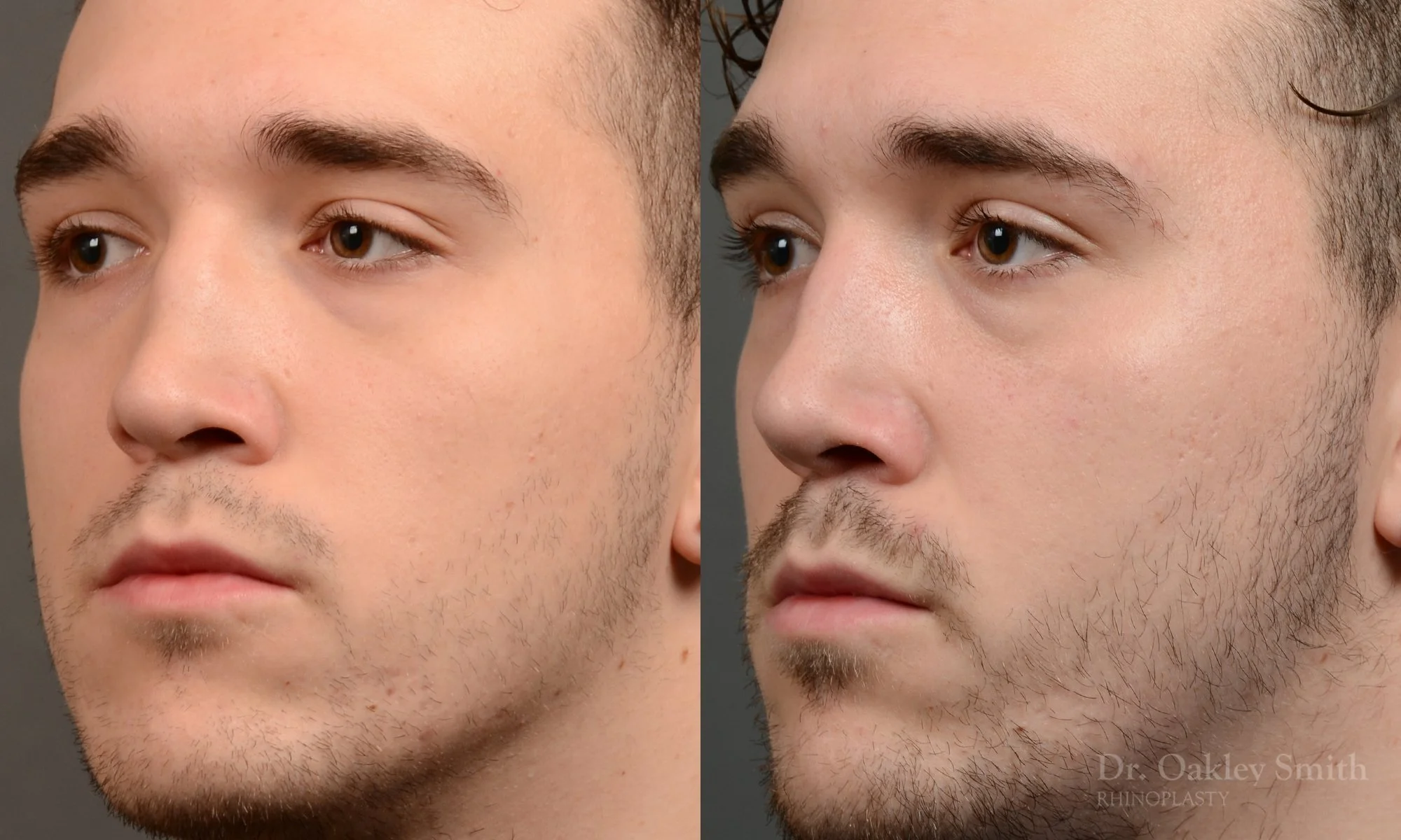 503D-male-rhinoplasty-dr-oakley-smith-toronto-top-surgeon-nose-job.jpg