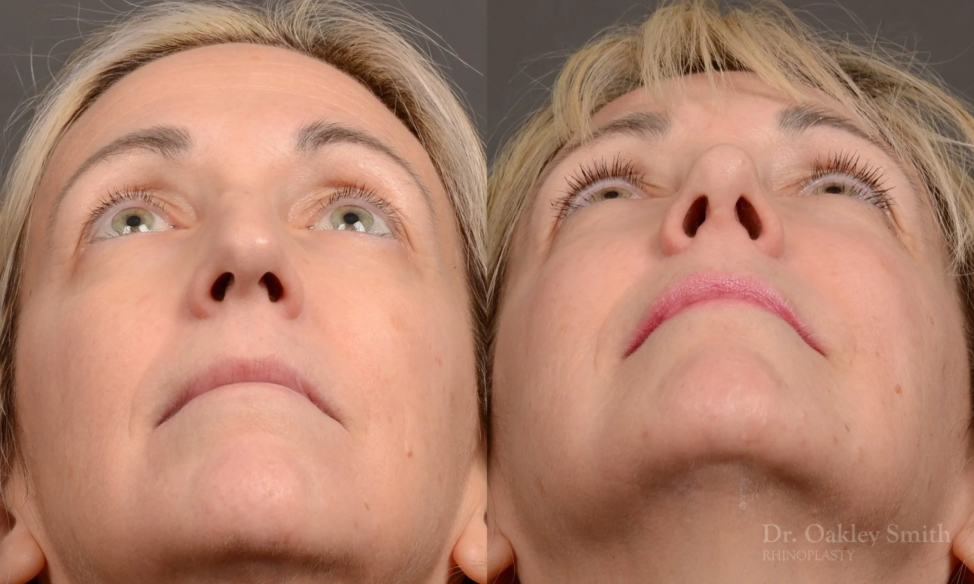 510F-rhinoplasty-dr-oakley-smith-toronto-top-surgeon-nose-job.jpg