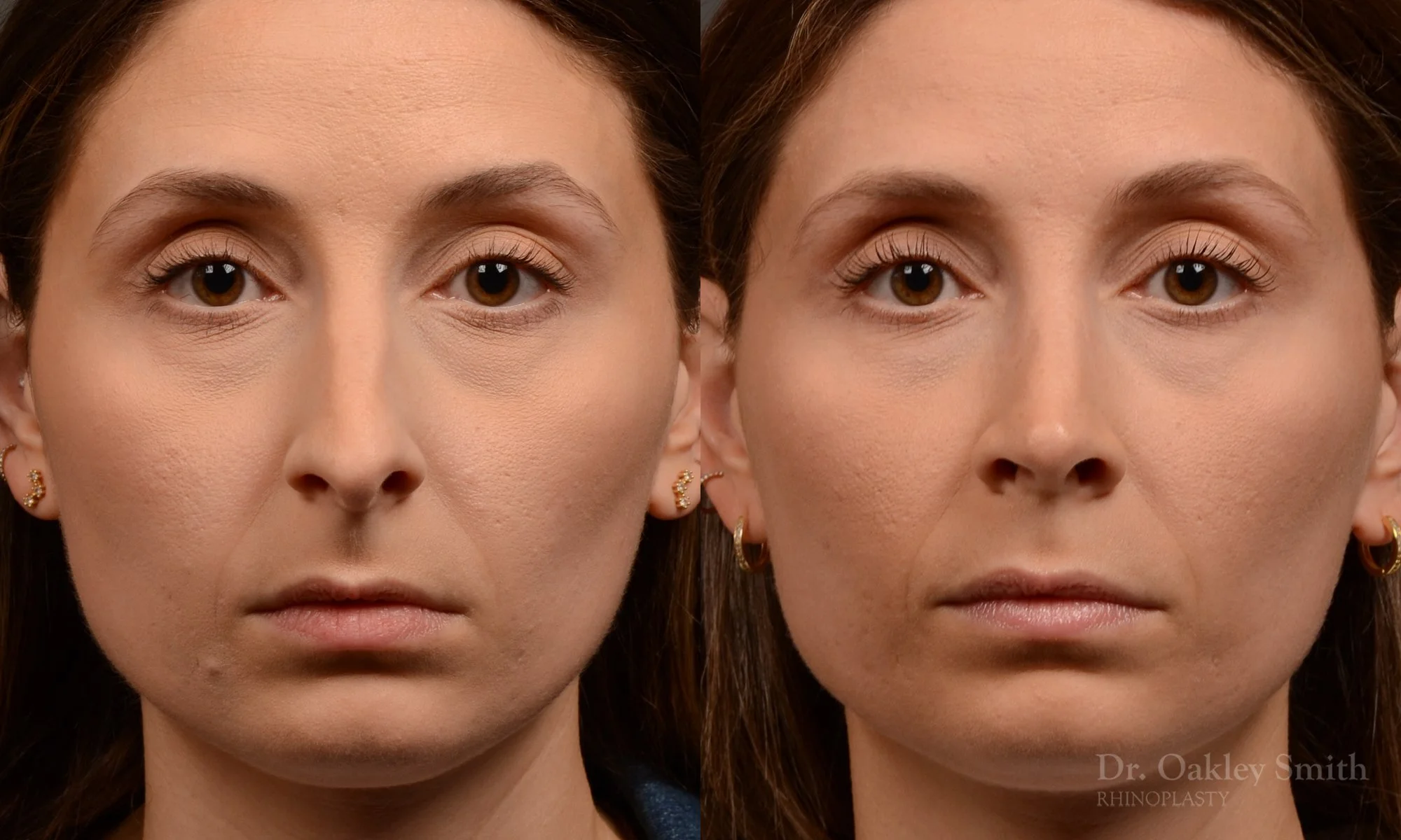 541A-rhinoplasty-dr-oakley-smith-toronto-nose-job.jpg