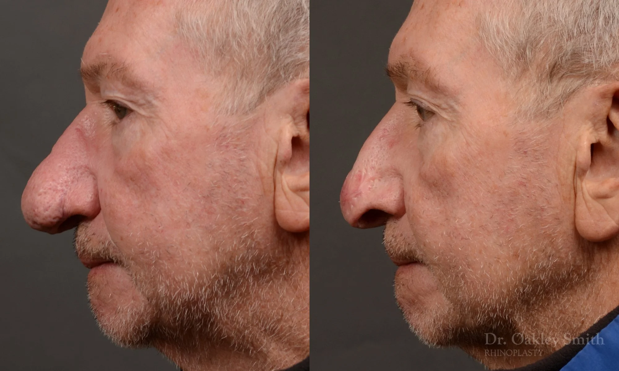 548E-Rhinophyma-nose-job-growth-toronto-nose-surgeon-dr.-oakley-smith.jpg