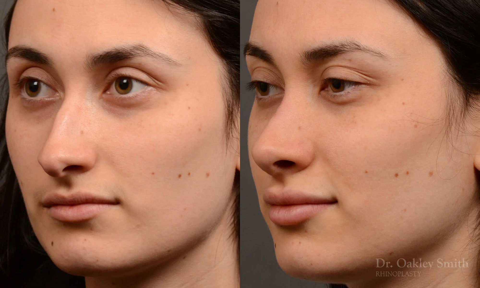 506D-rhinoplasty-dr-oakley-smith-toronto-top-surgeon-nose-job.jpg