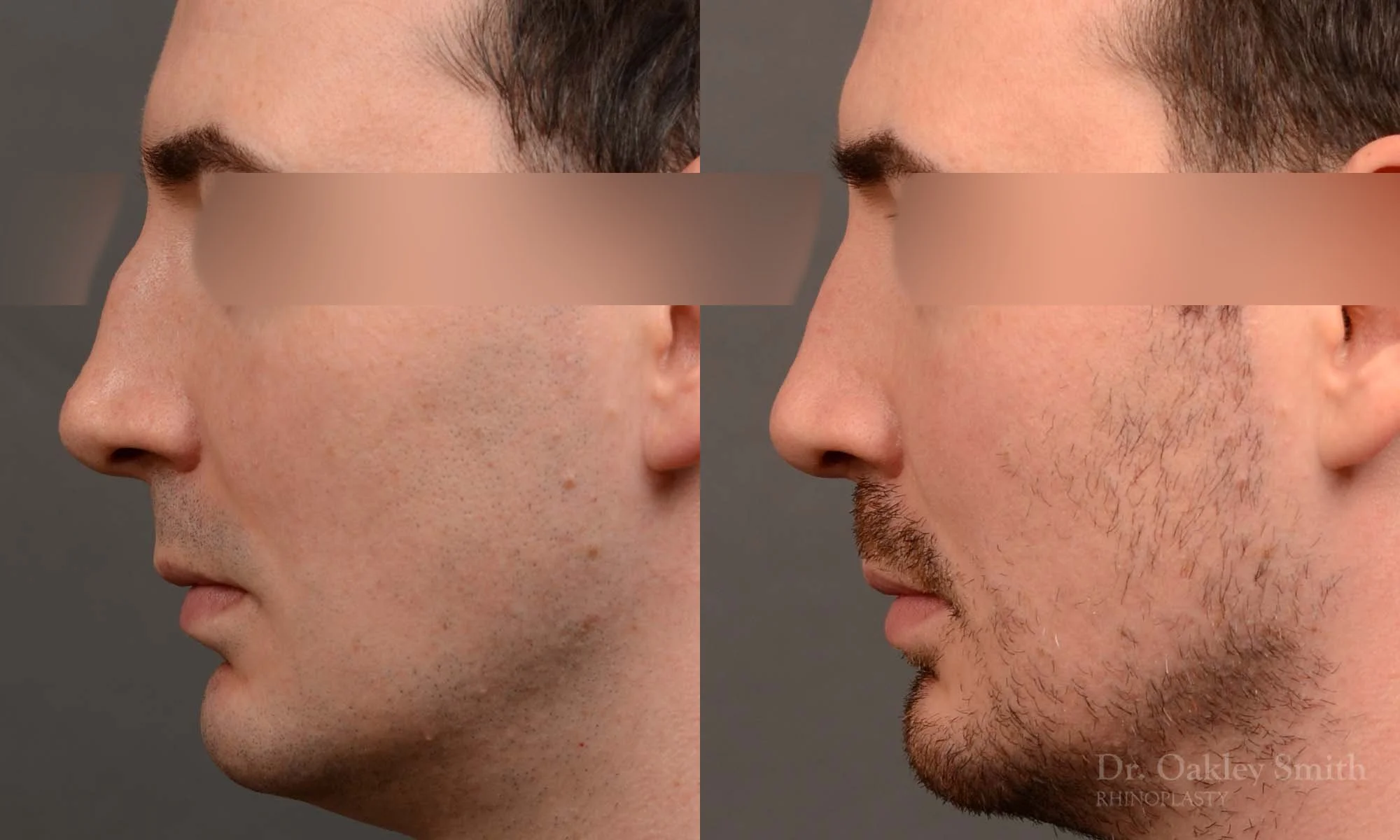 555E male rhinoplasty, nose job, toronto nose surgeon, dr oakley smith.jpg