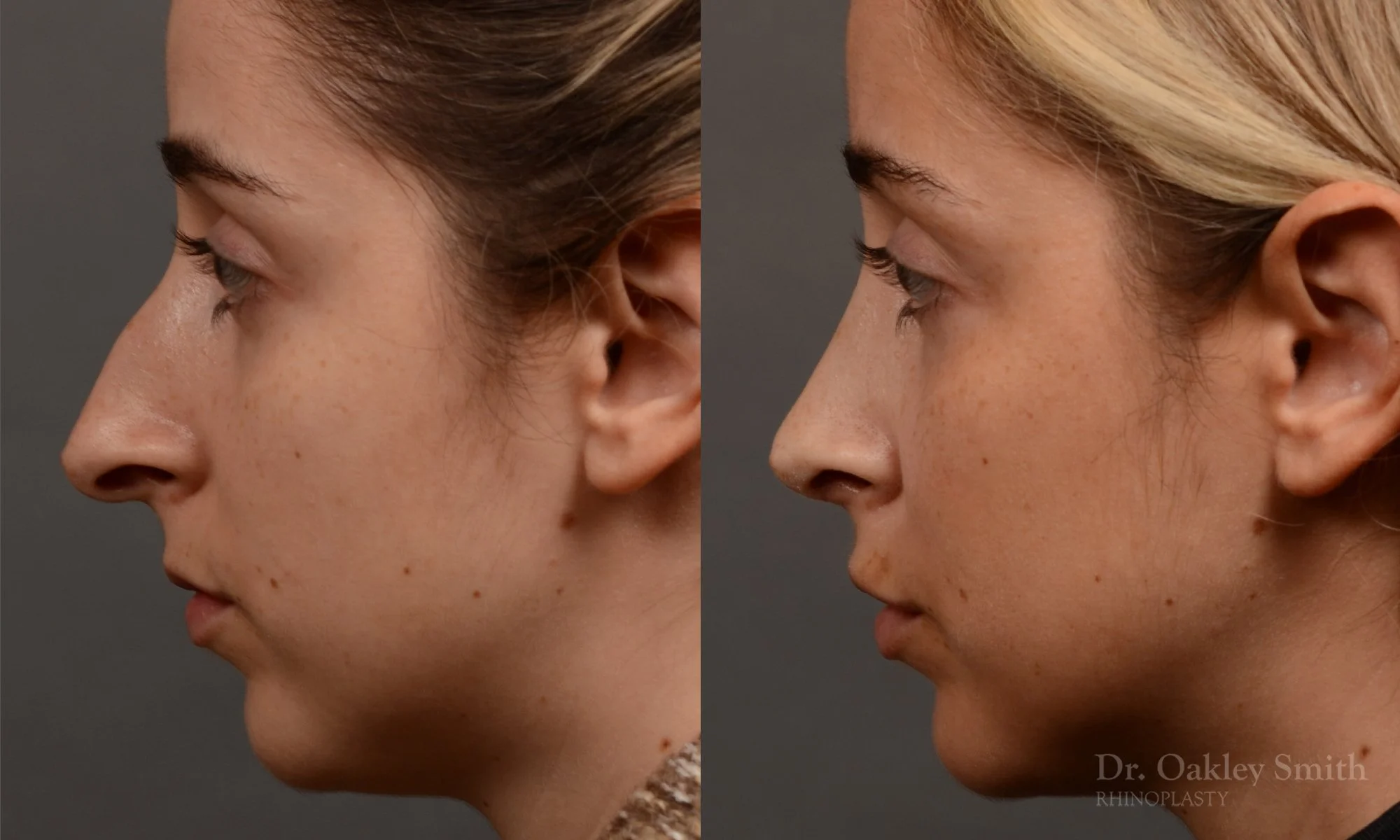 286E-rhinoplasty-dr-oakley-smith-toronto-nose-job.jpg