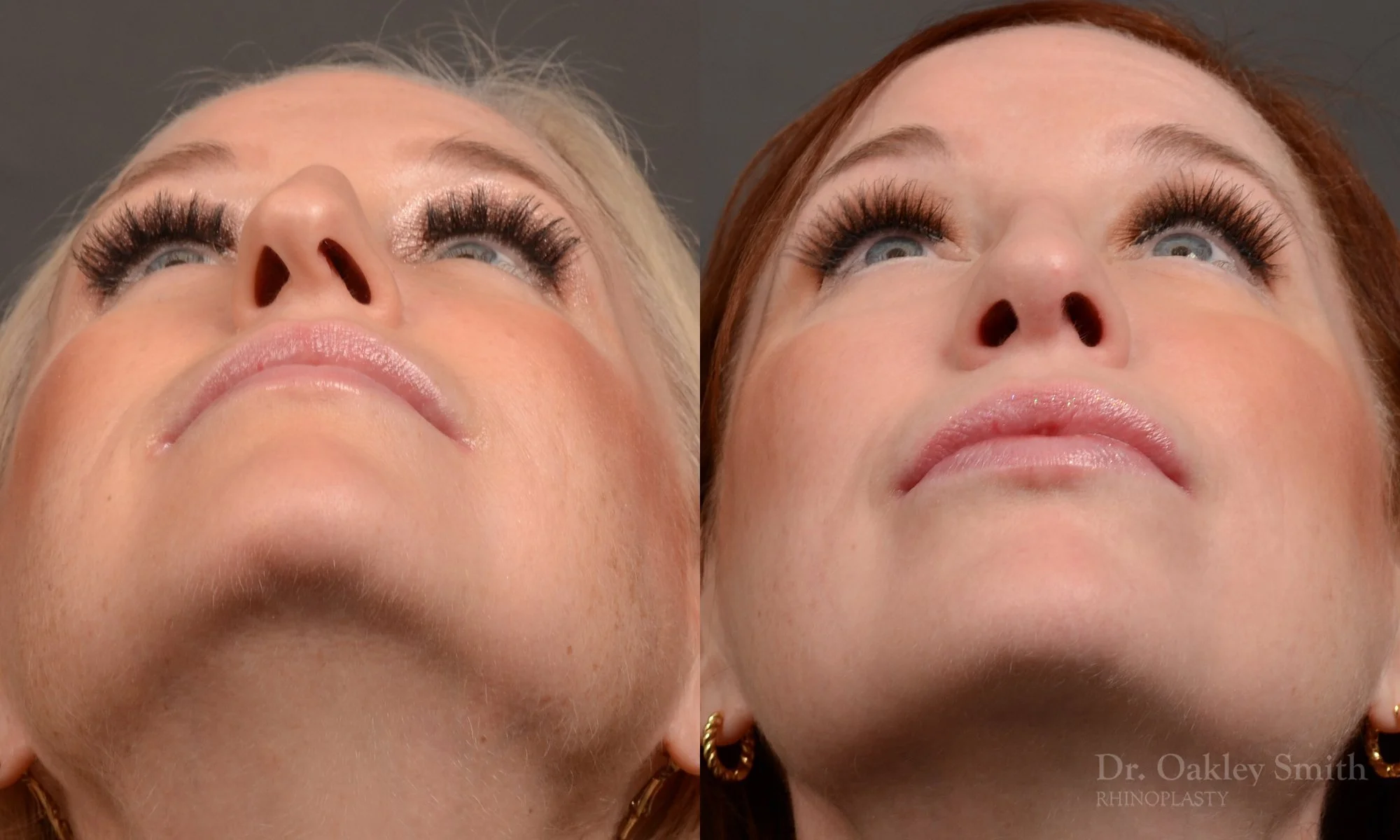 528F-rhinoplasty-dr-oakley-smith-toronto-top-surgeon-nose-job.jpg