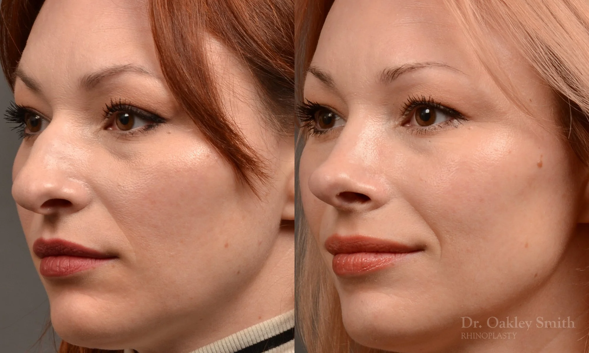 472D-rhinoplasty-dr-oakley-smith-toronto-top-surgeon-nose-job.jpg