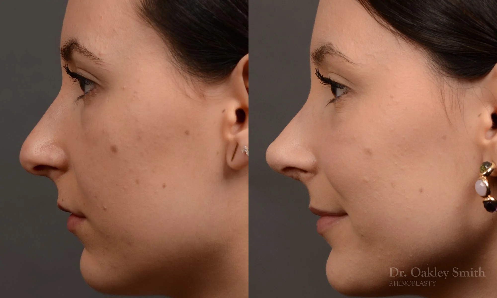449.1E-revision-rhinoplasty-dr-oakley-smith-toronto-top-surgeon-nose-job.jpg