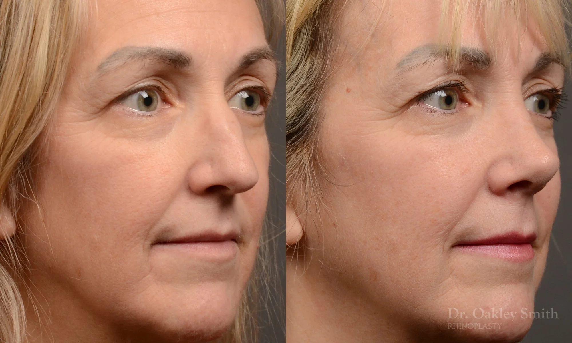 510B-rhinoplasty-dr-oakley-smith-toronto-top-surgeon-nose-job.jpg