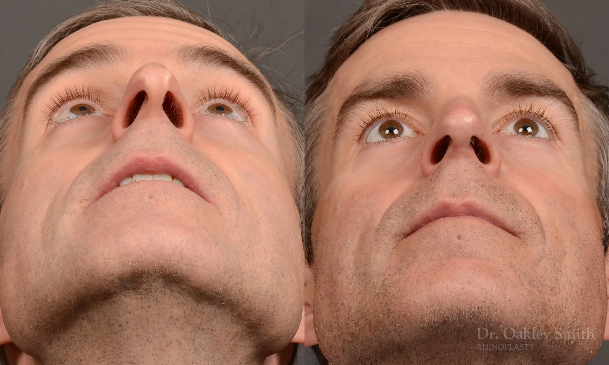 535F-male-rhinoplasty-dr-oakley-smith-toronto-top-surgeon-nose-job.jpg