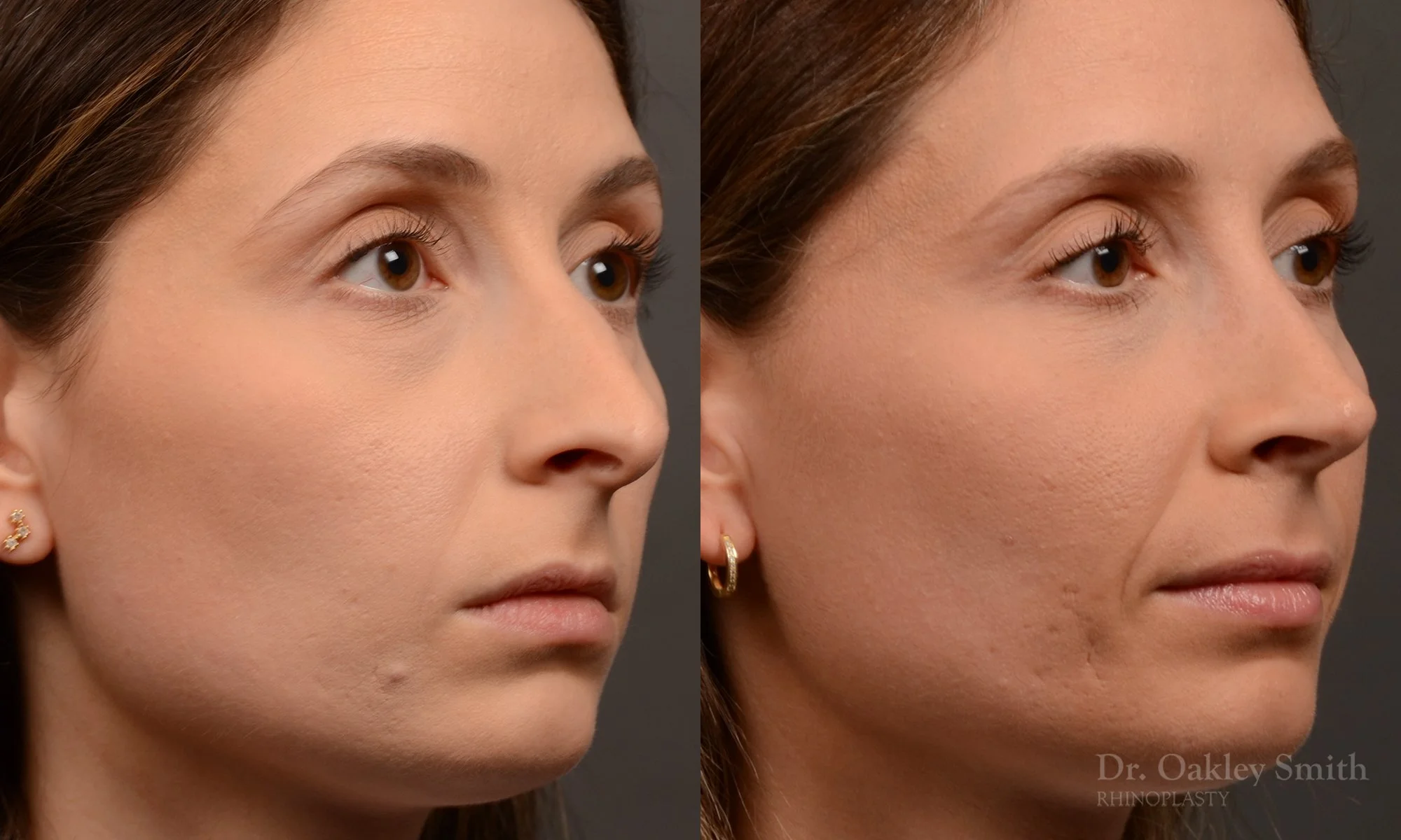 541B-rhinoplasty-dr-oakley-smith-toronto-nose-job.jpg