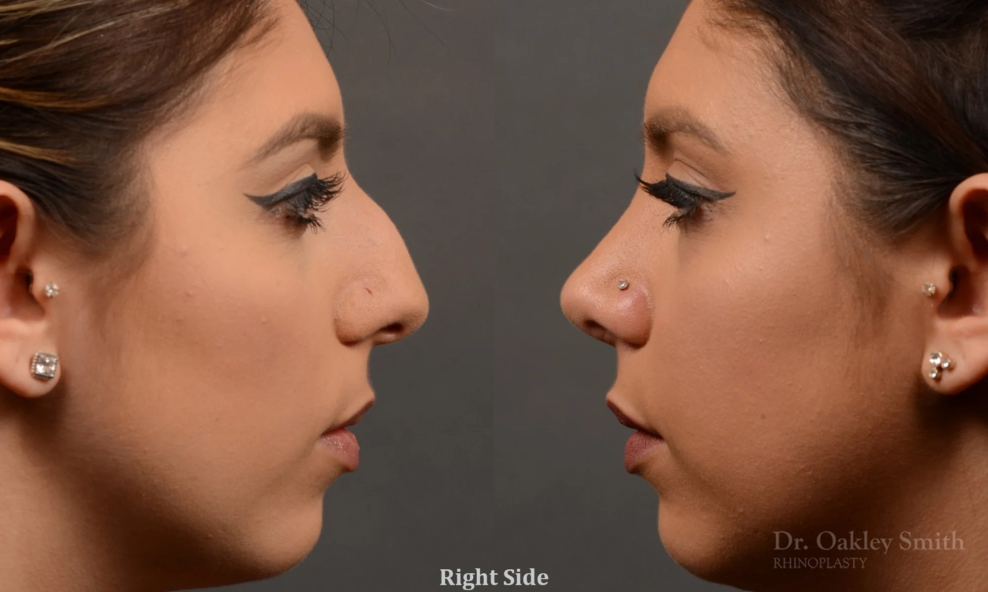 350: Female, Ethnic Rhinoplasty, Thick Skin, Dorsal Hump, Tip Refinement