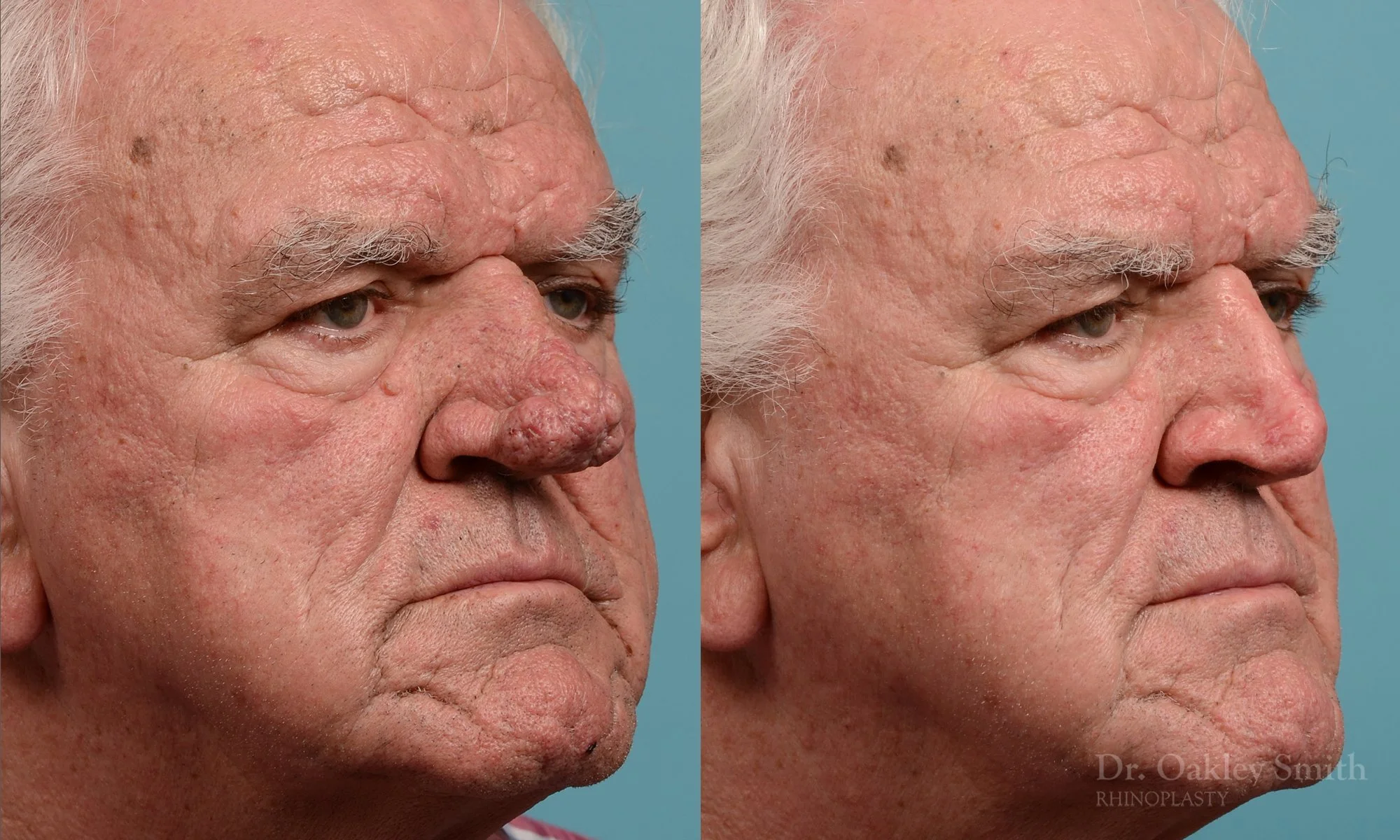245B-rhinophyma-nose-job-rhinoplasty-dr-oakley-smith-toronto-1.jpg