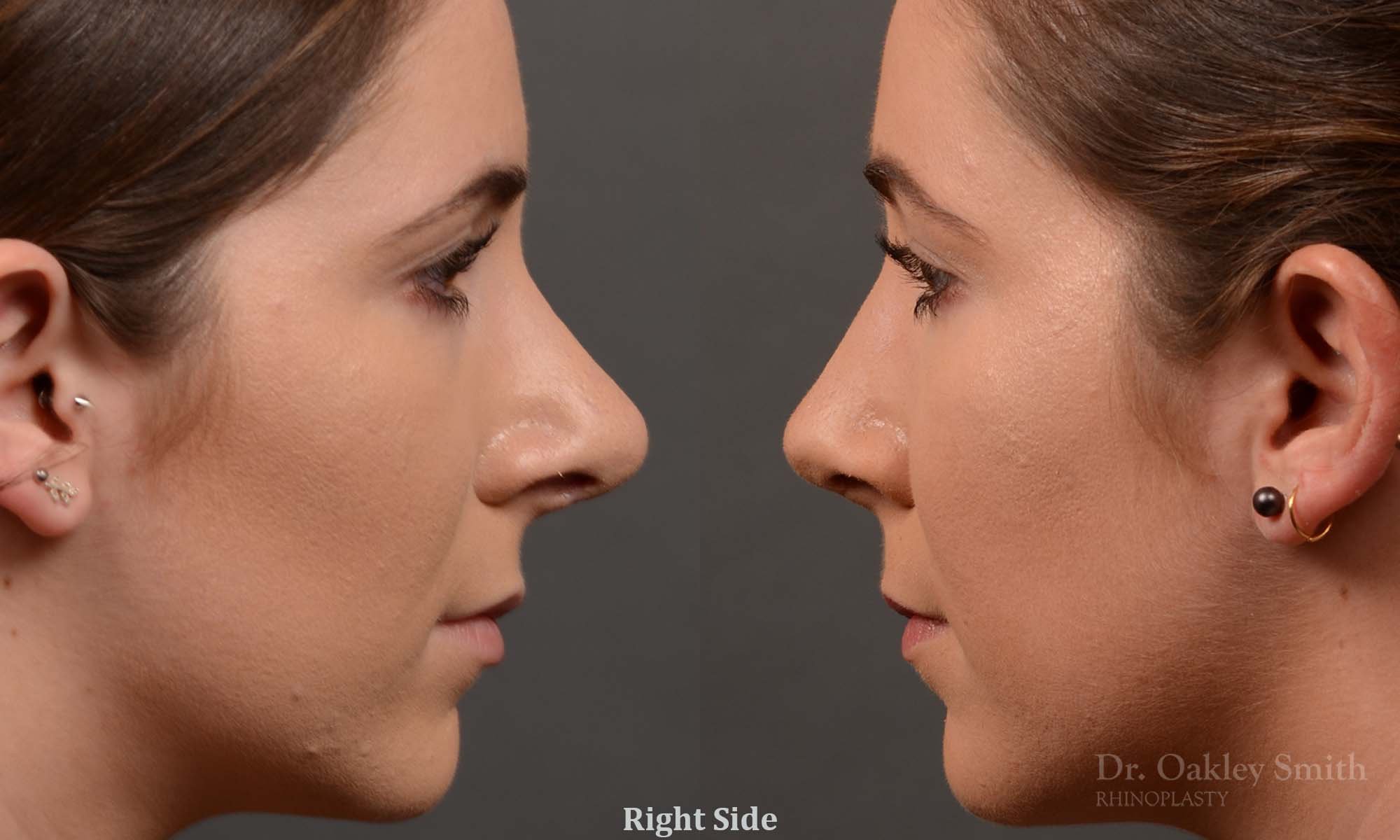 366: Female Rhinoplasty, Large Nose, Dorsal Hump, Tip Narrowing