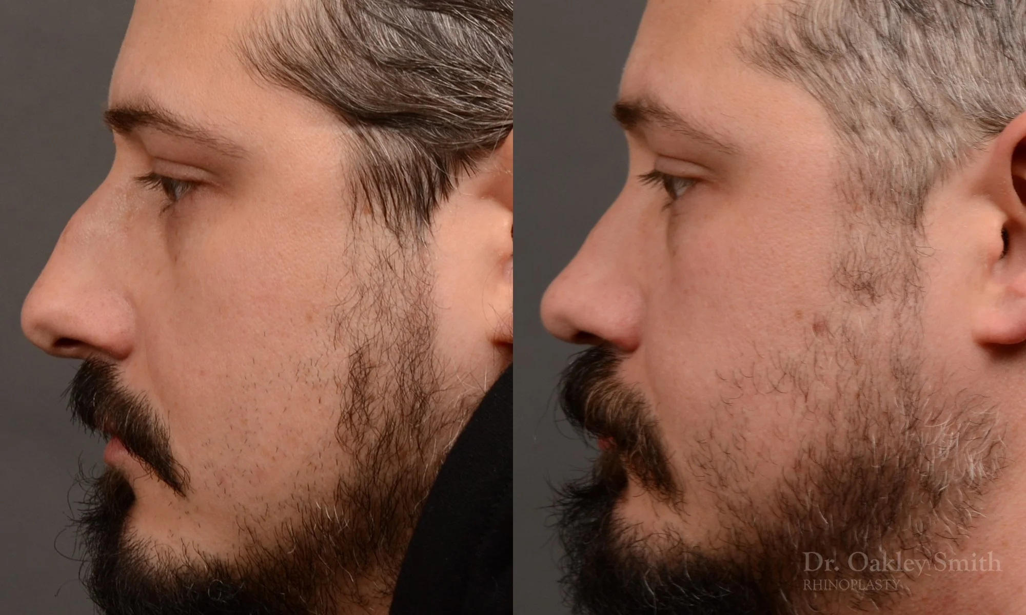 501E-male-rhinoplasty-dr-oakley-smith-toronto-top-surgeon-nose-job.jpg