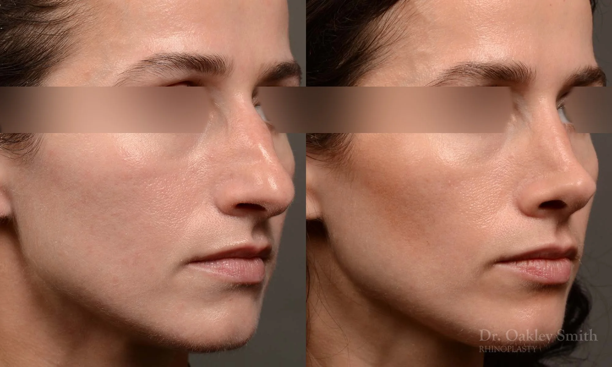 529B-rhinoplasty-dr-oakley-smith-toronto-top-surgeon-nose-job.jpg
