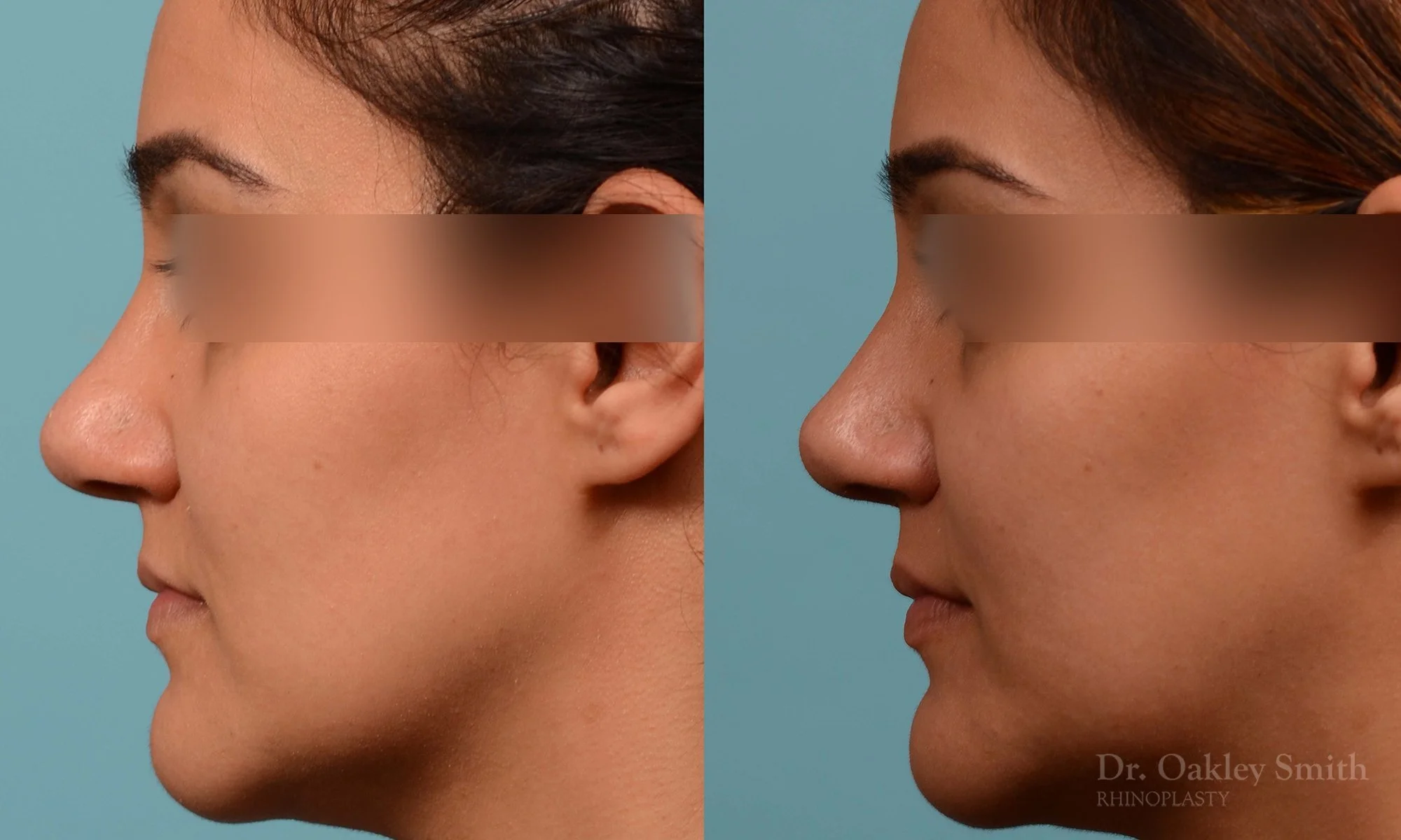 223E-nose-job-long-nose-rhinoplasty-dr-oakley-smith-curved-nose-wide-base-of-nose-projected-tip-weir-incisions-1-1.jpg