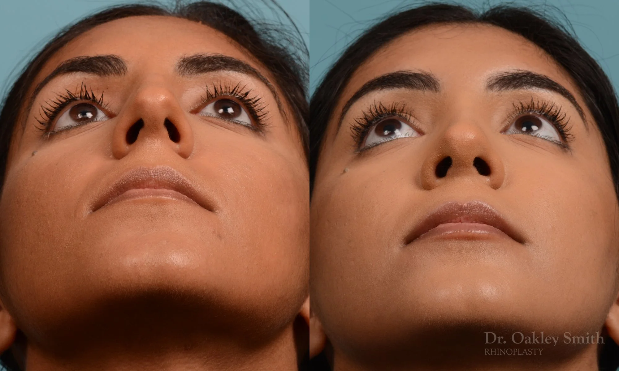 303.1F-rhinoplasty-dr-oakley-smith-toronto-nose-job.jpg