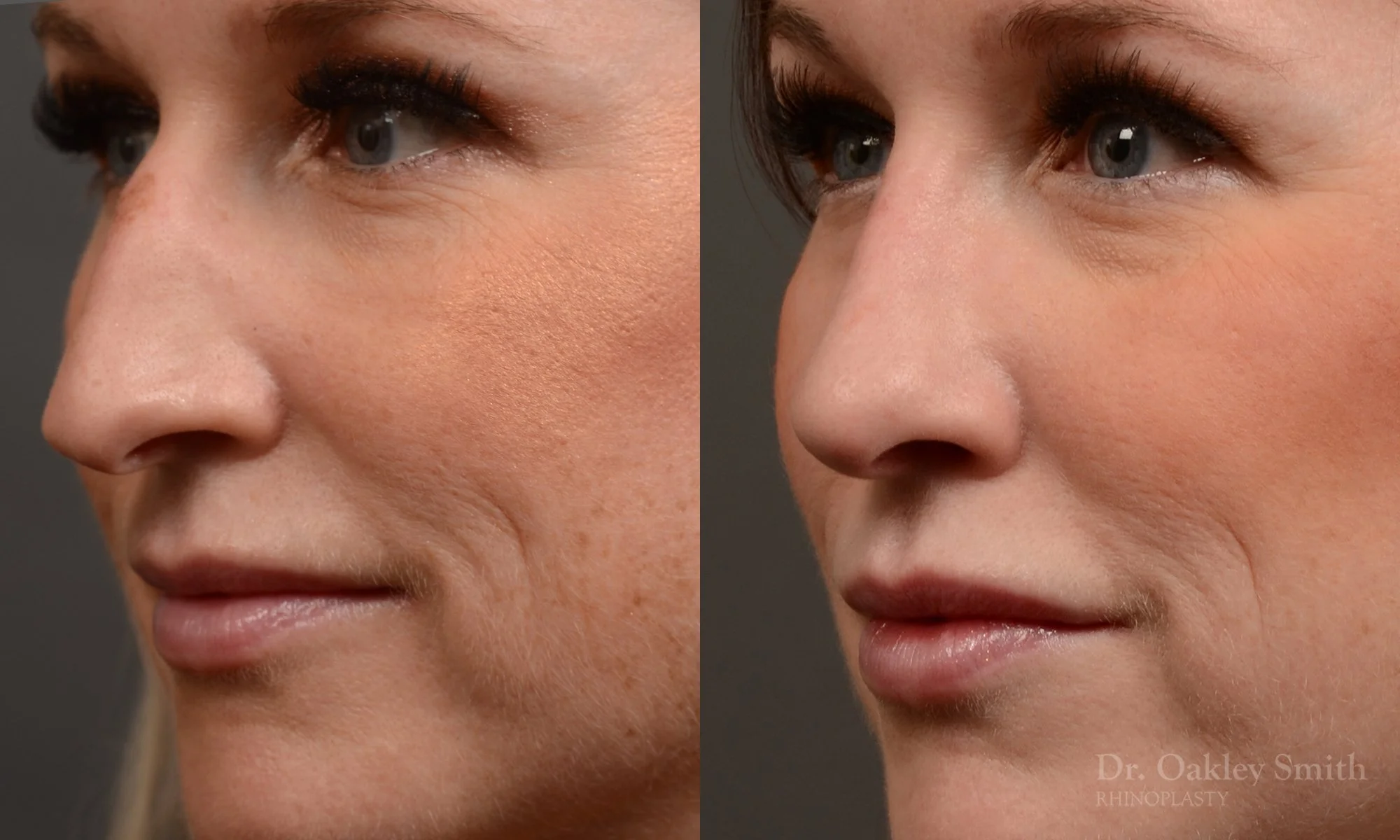528D-rhinoplasty-dr-oakley-smith-toronto-top-surgeon-nose-job.jpg