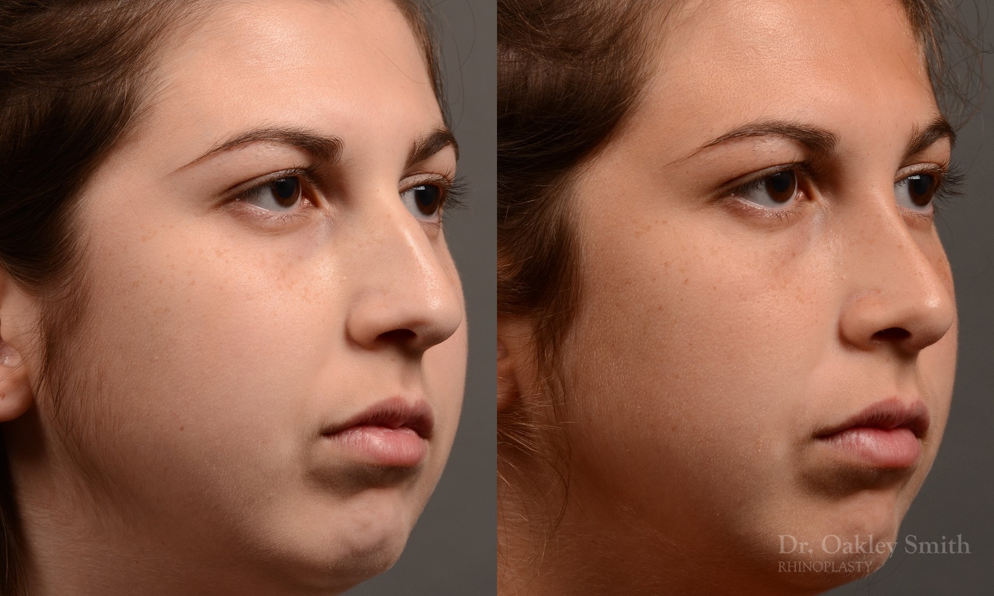 371B-rhinoplasty-dr-oakley-smith-toronto-nose-job.jpg
