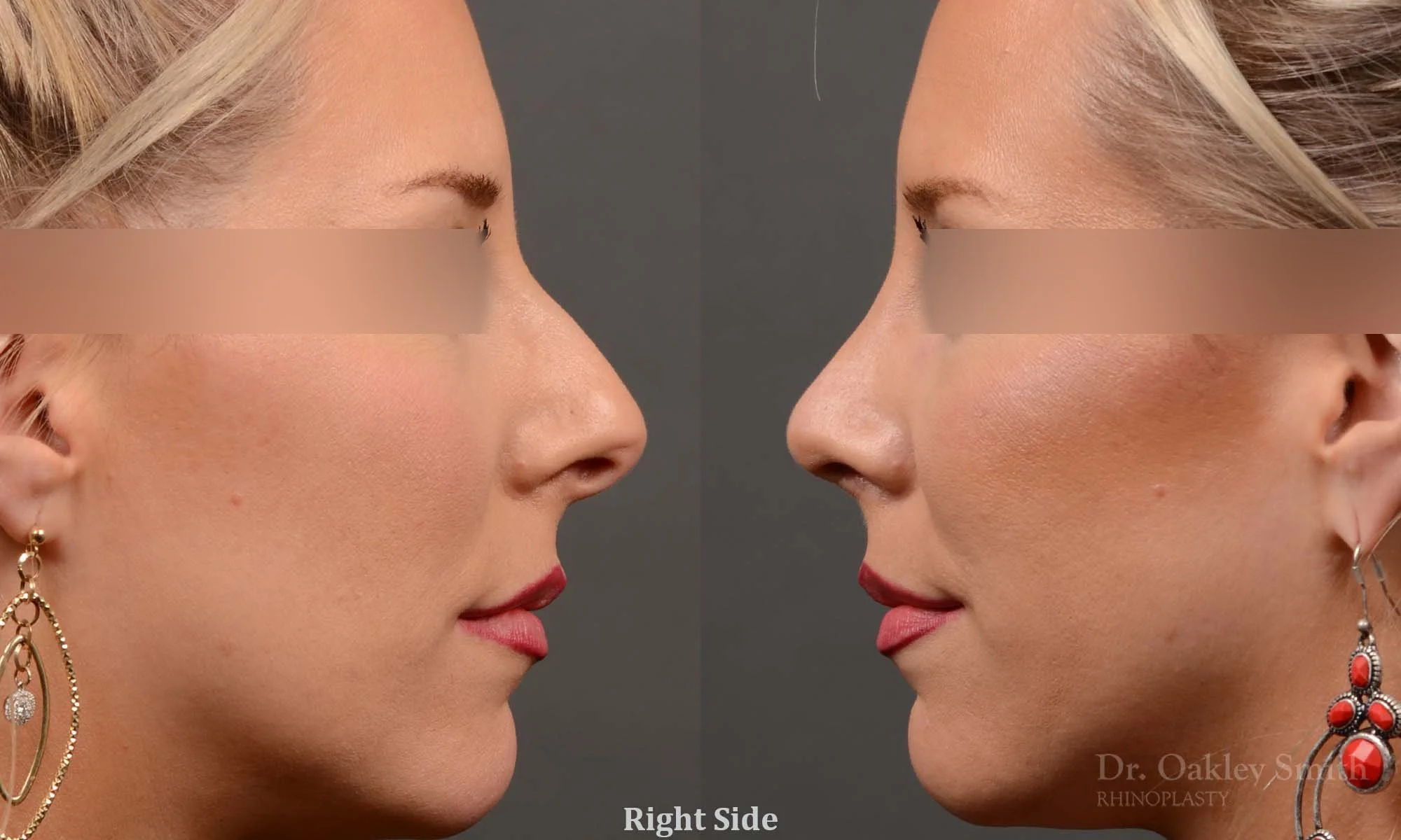 307C-rhinoplasty-dr-oakley-smith-nose-job-toronto.jpg