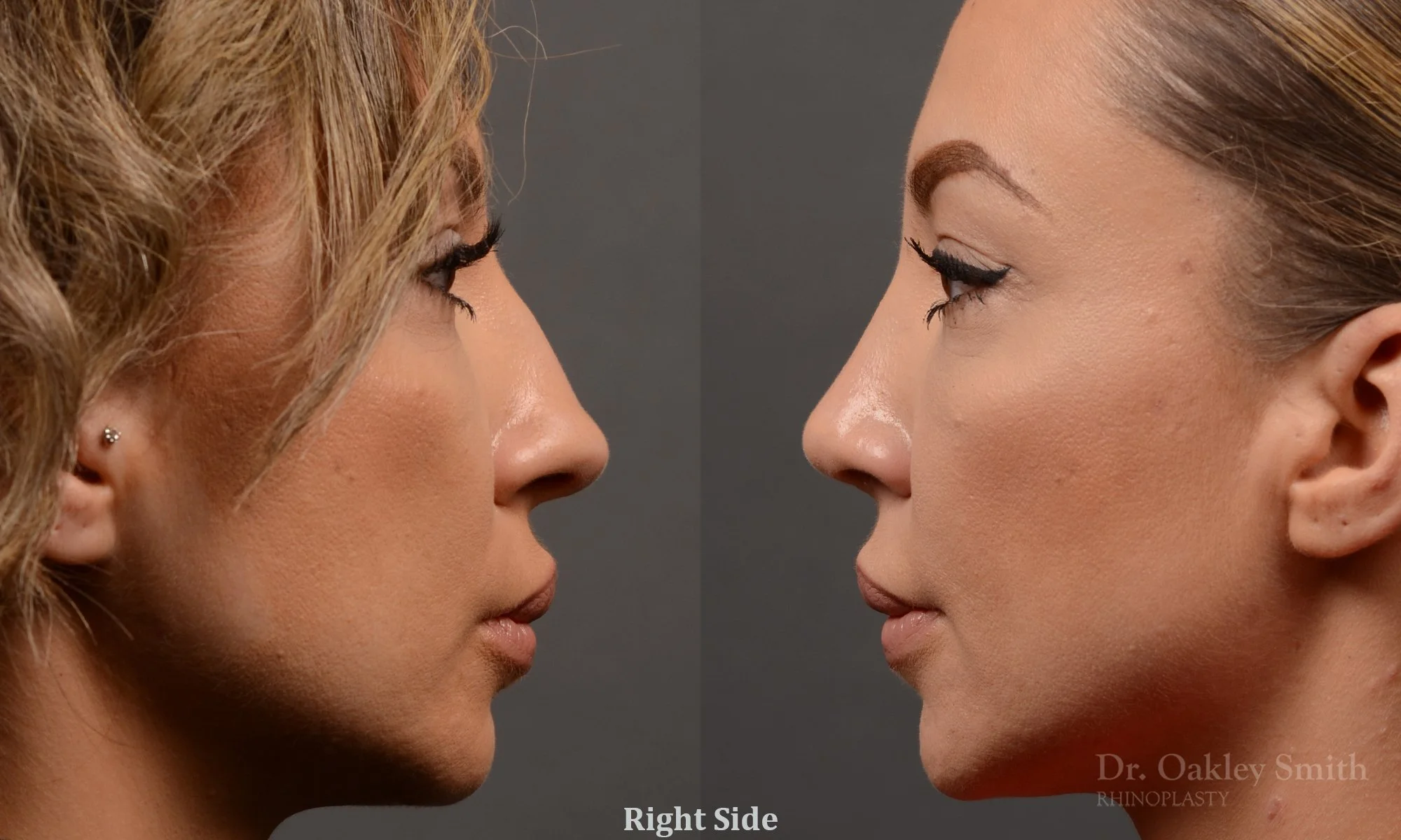354C-rhinoplasty-dr-oakley-smith-toronto-nose-job.jpg