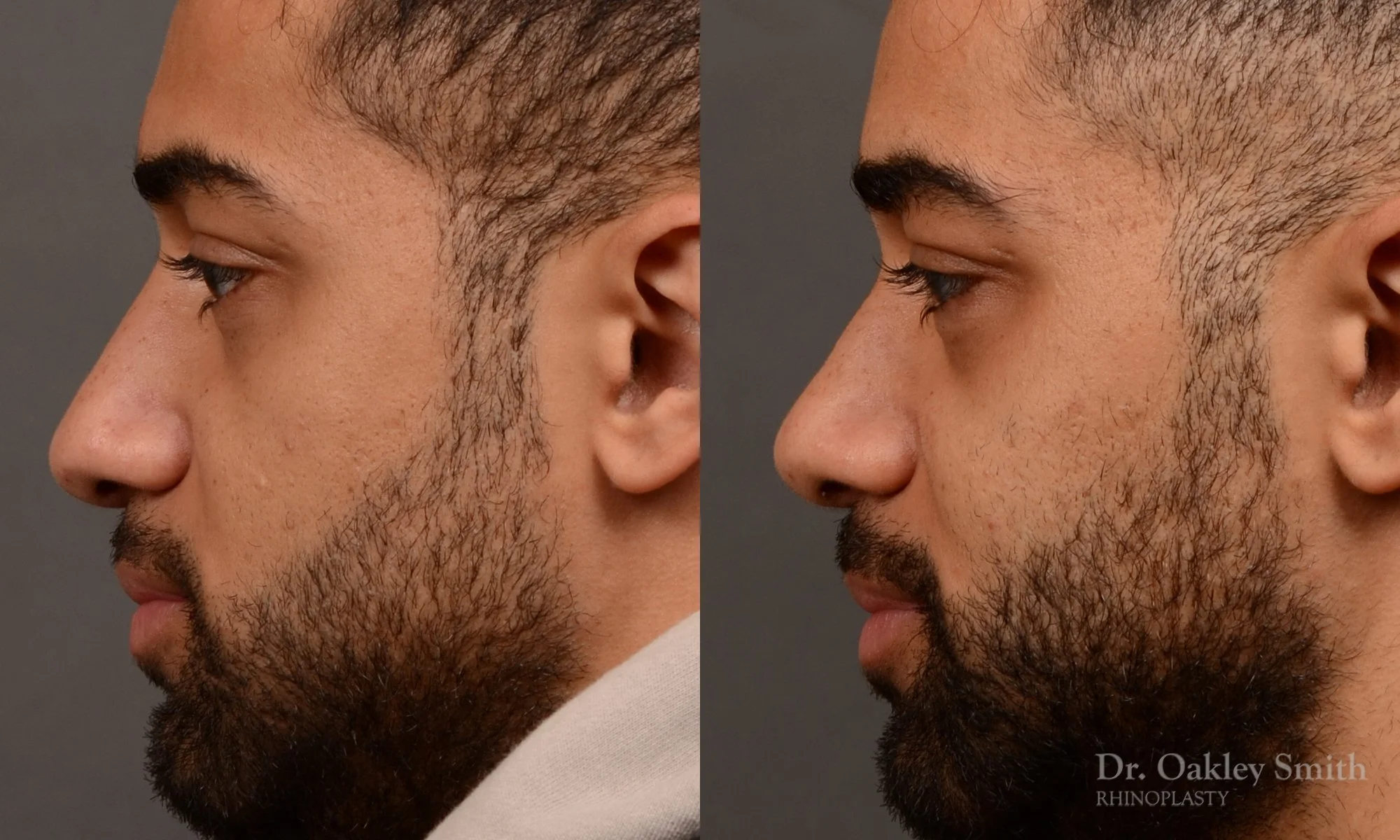 544E-male-rhinoplasty-before-and-after-nose-job-toronto-Dr.-Oakley-Smith.jpg